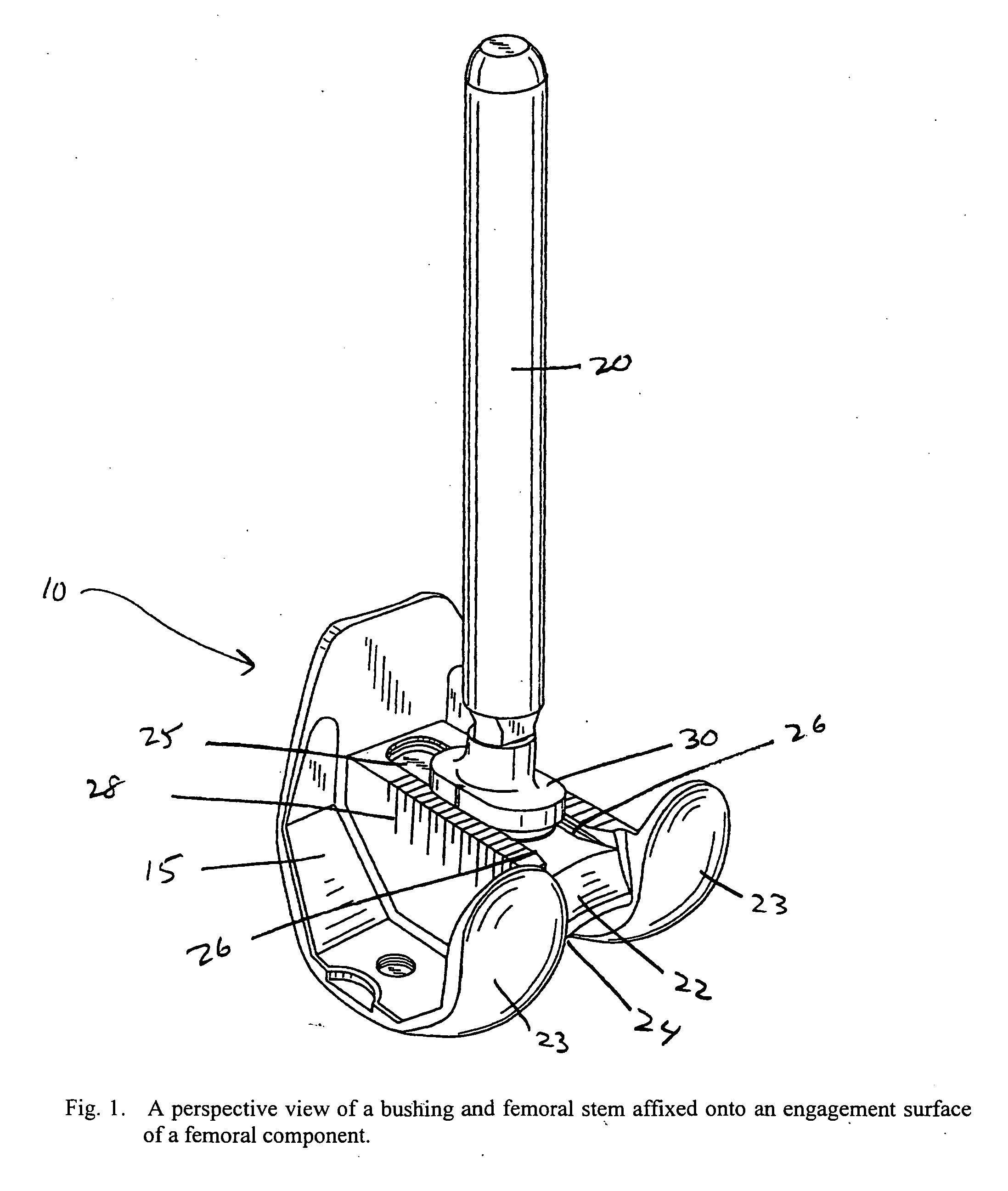 Prosthetic revision knee system