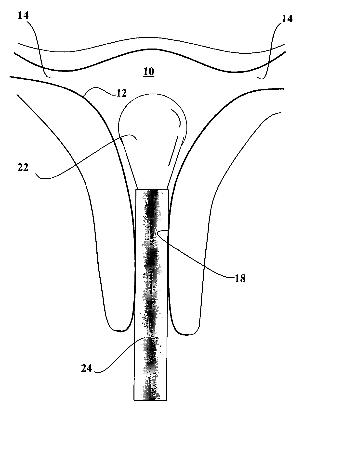 Dip-molded polymeric medical devices with reverse thickness gradient, and method of making same