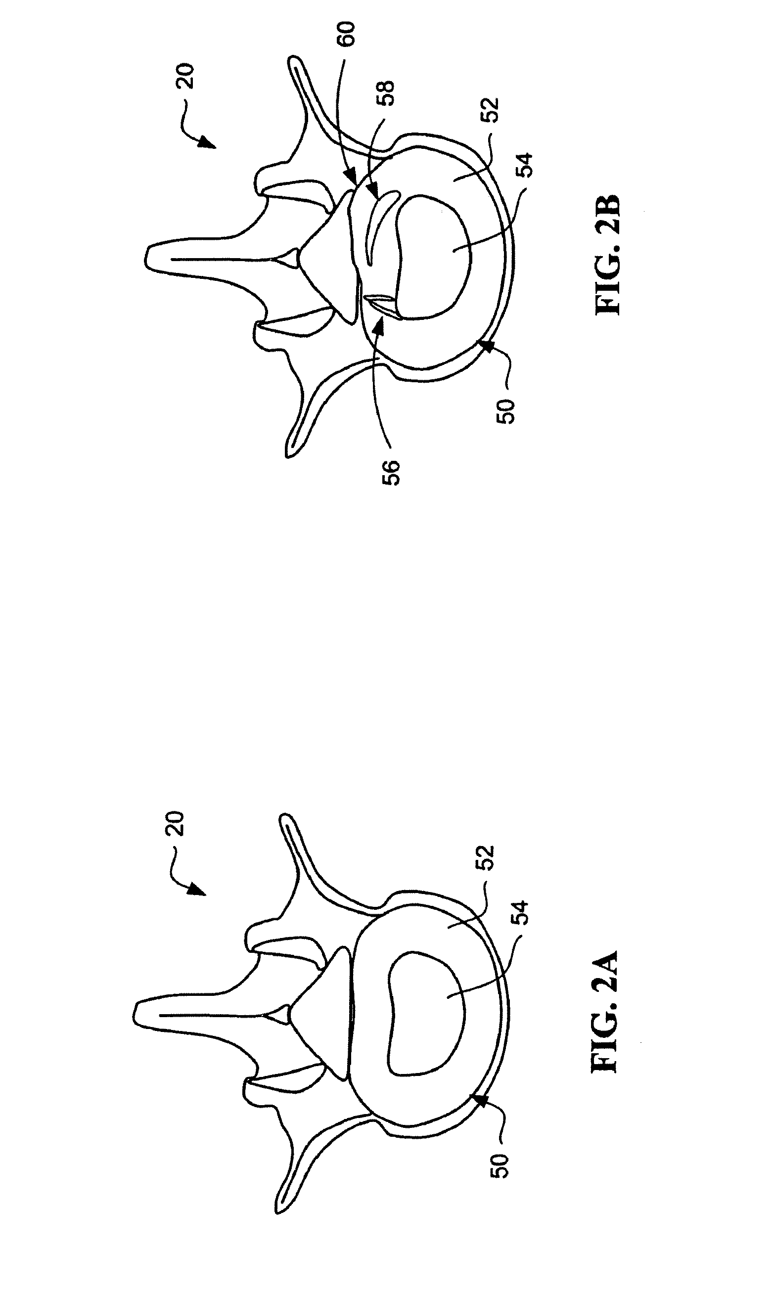 Devices and Methods for Annular Repair of Intervertebral Discs