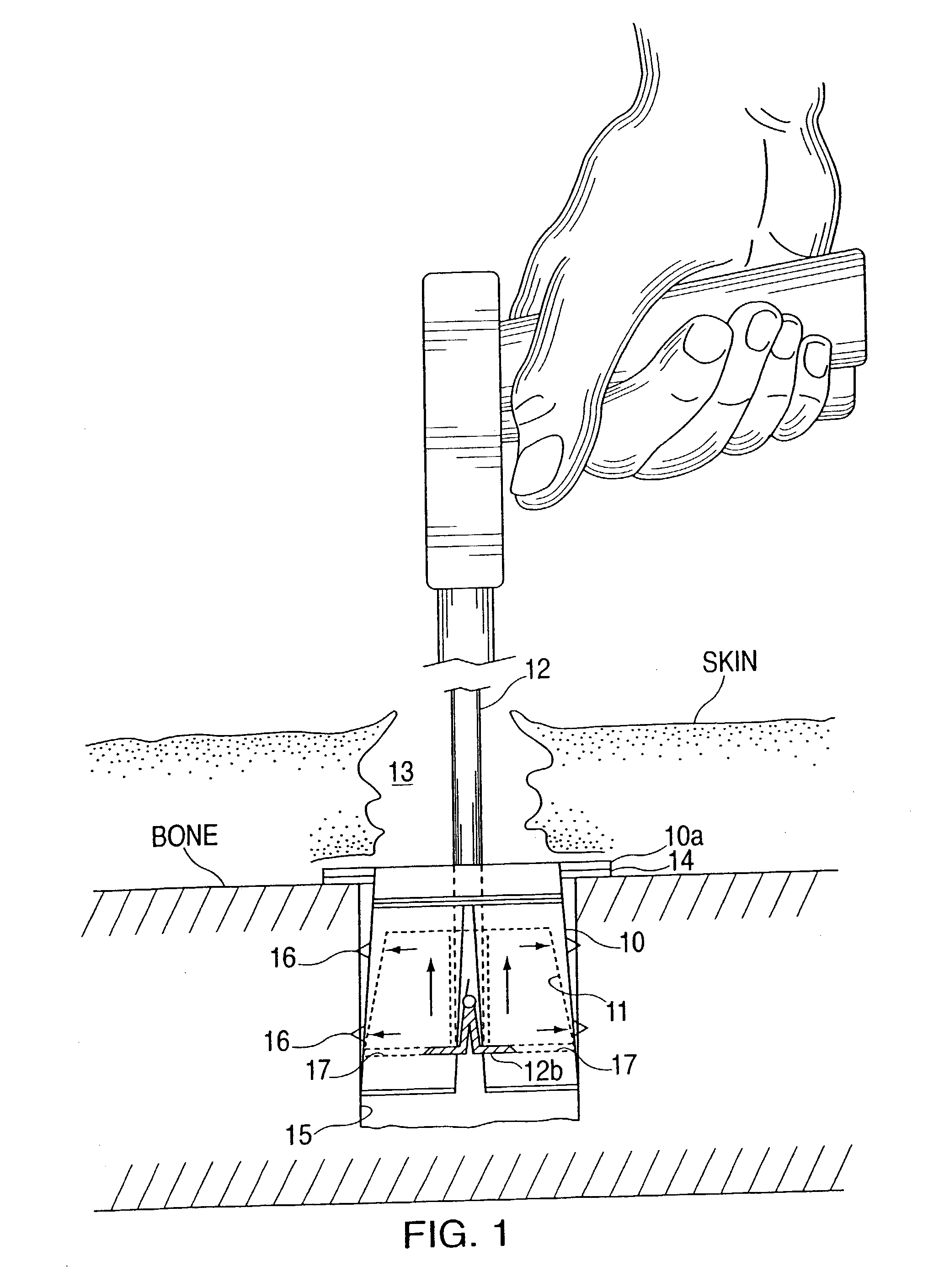 Device for installing an anchor in a bone