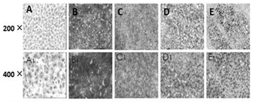 Application of CPT-II in malignant transformation process induced by fat accumulation of liver cells