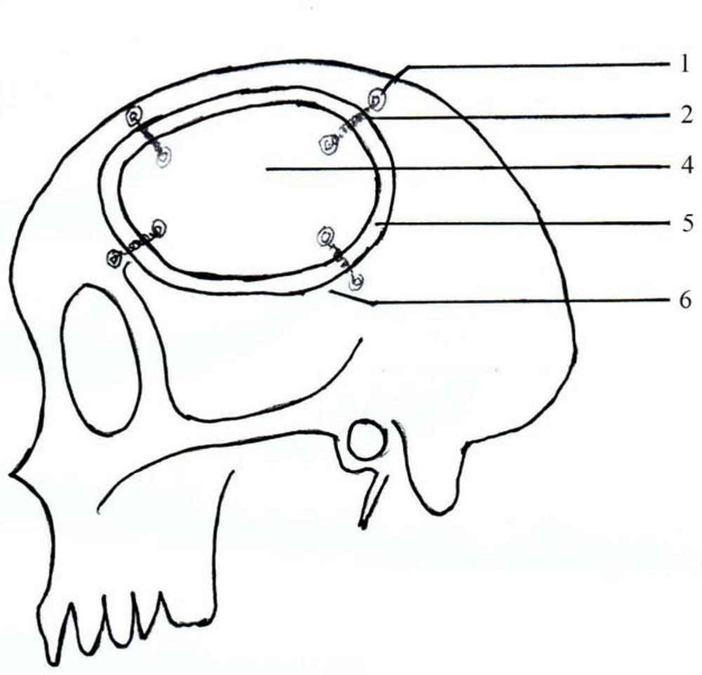 A skull decompression connector