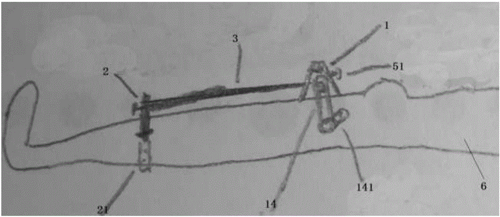 Tibial tuberosity traction nail embedding guider