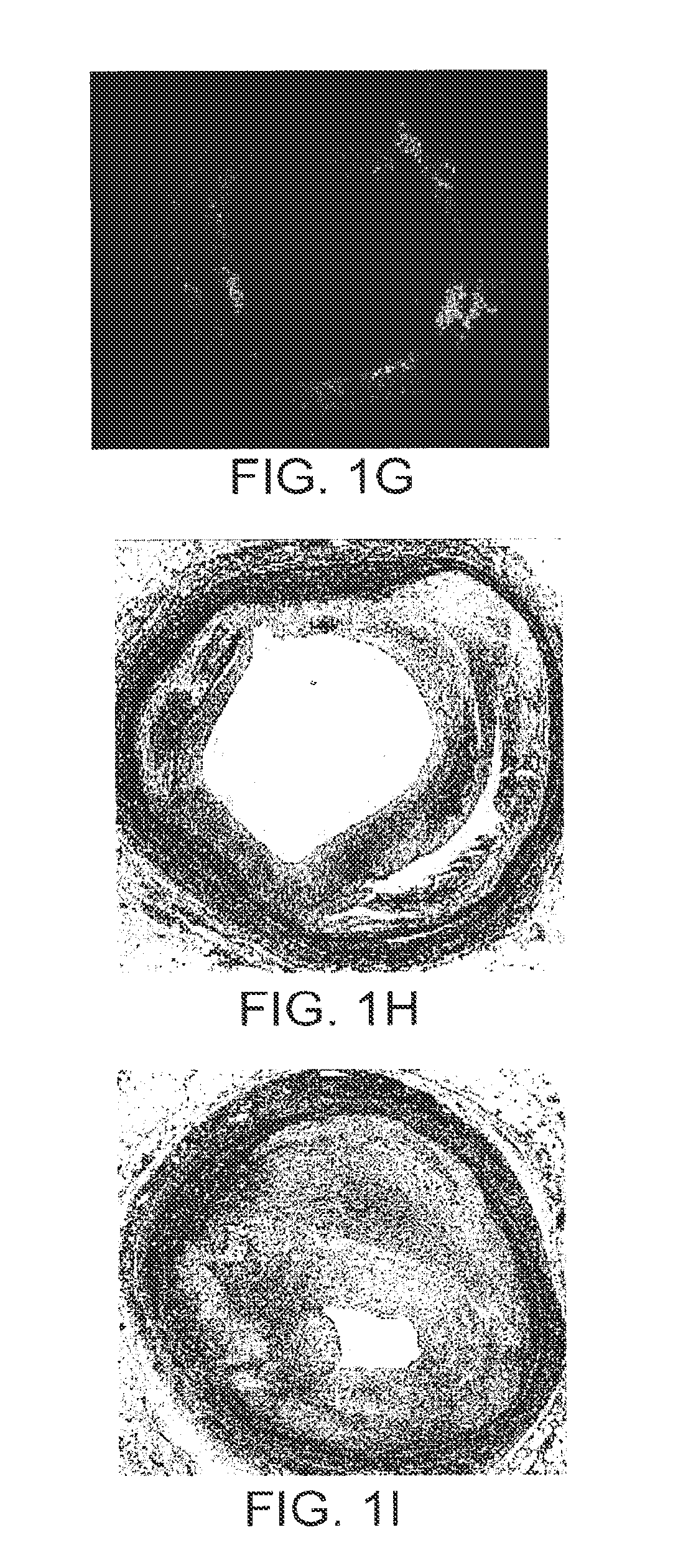 Imaging and Eccentric Atherosclerotic Material Laser Remodeling and/or Ablation Catheter