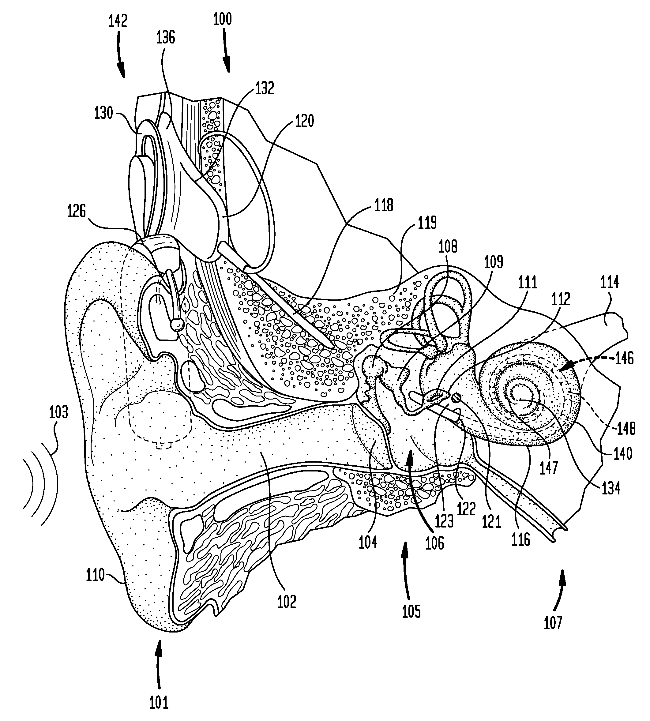 Implantable microphone system