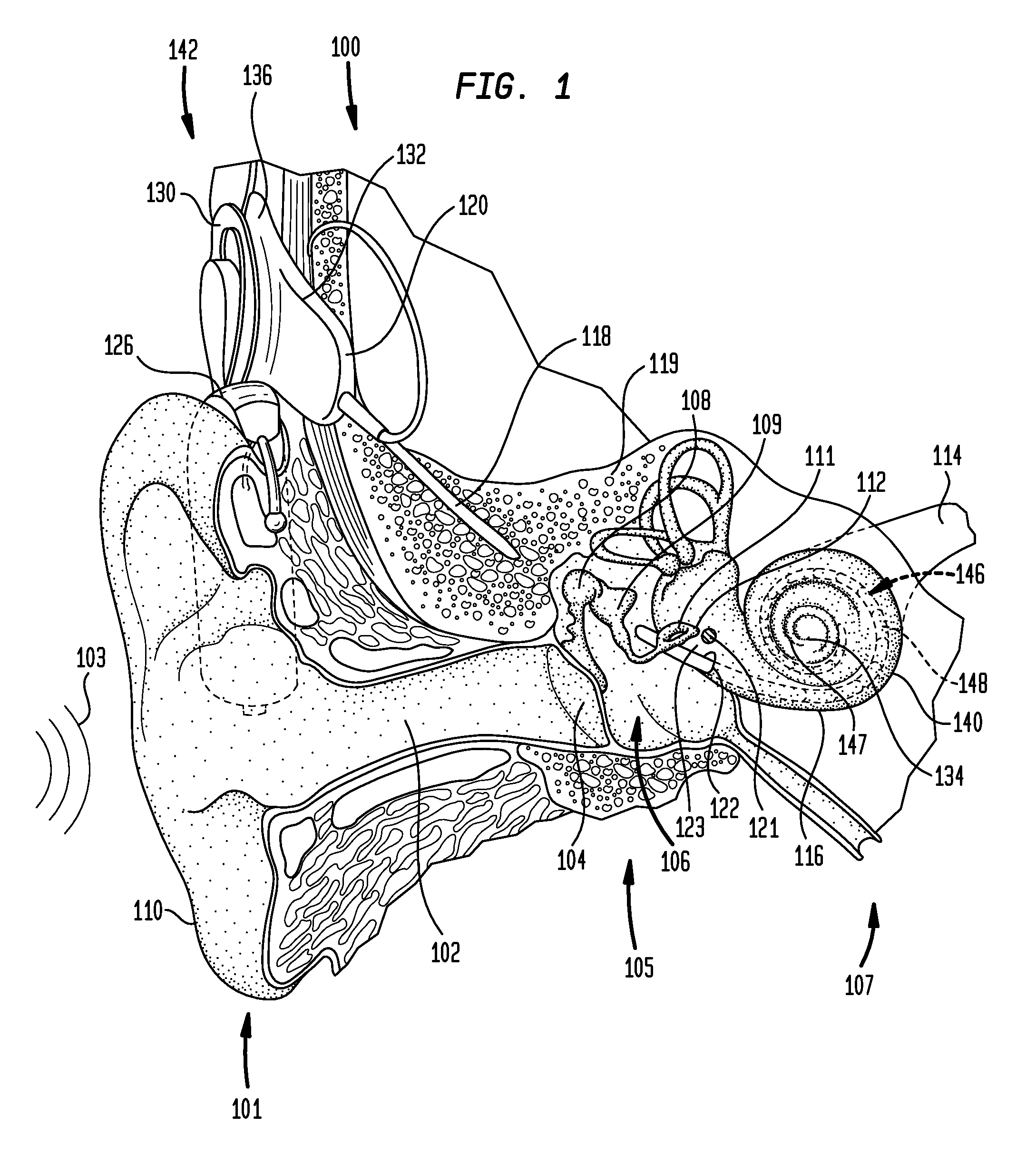 Implantable microphone system