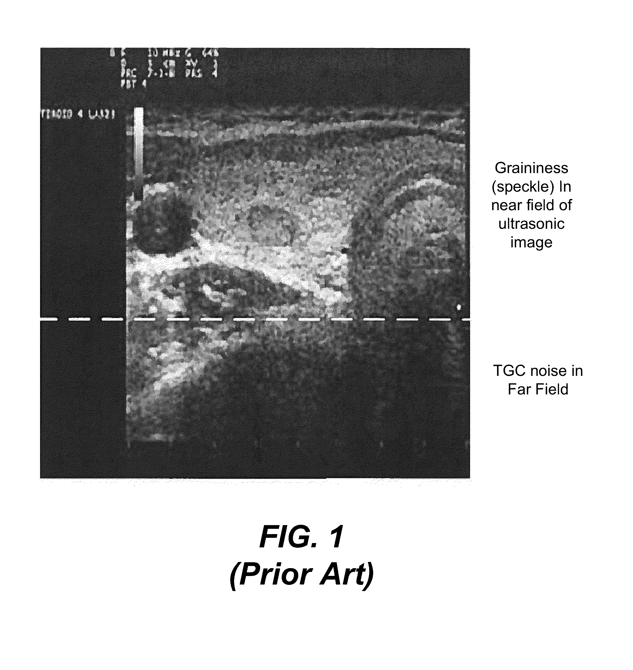 Speckle and noise reduction in ultrasound images