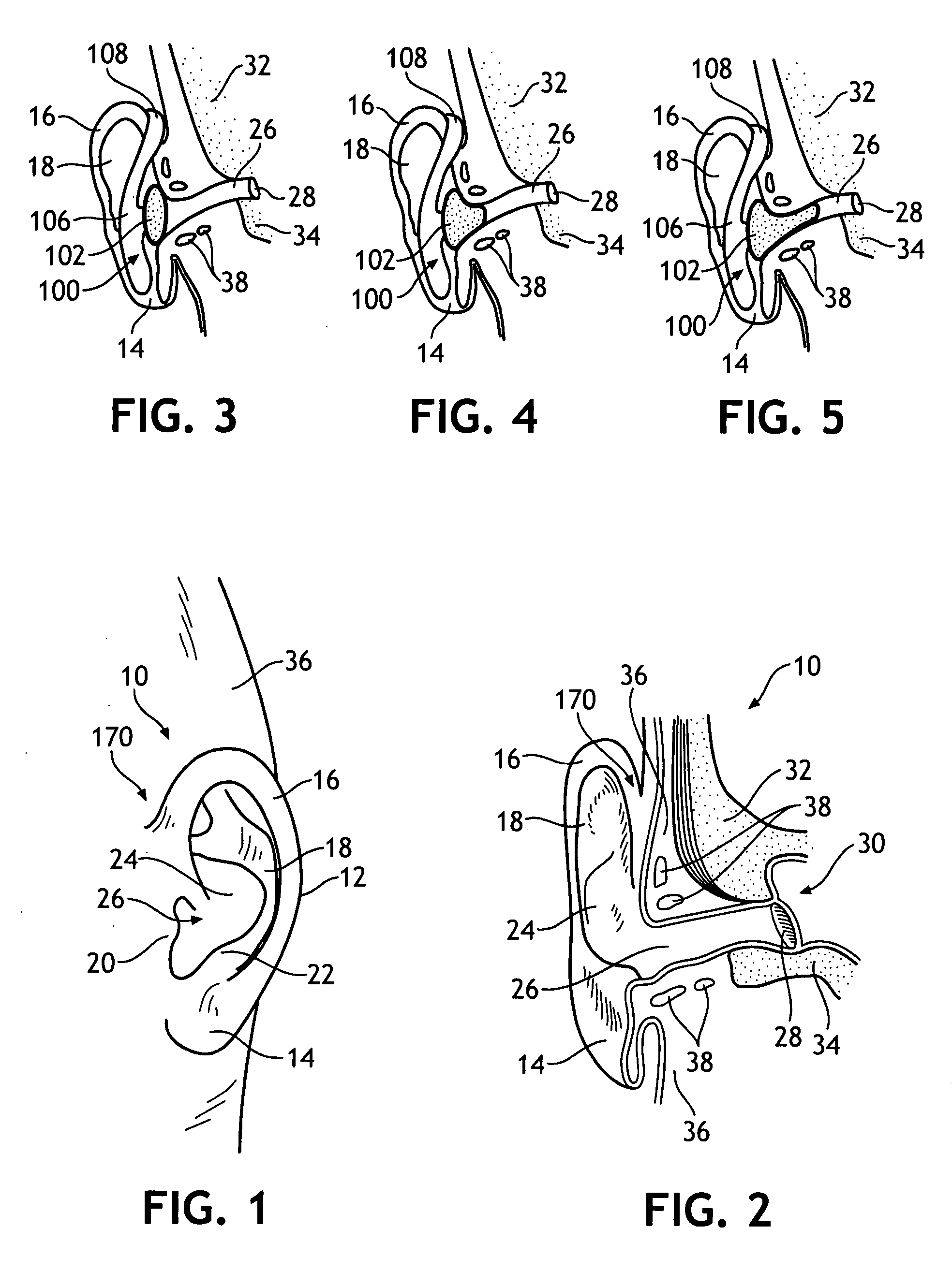 Clip-style hearing protector