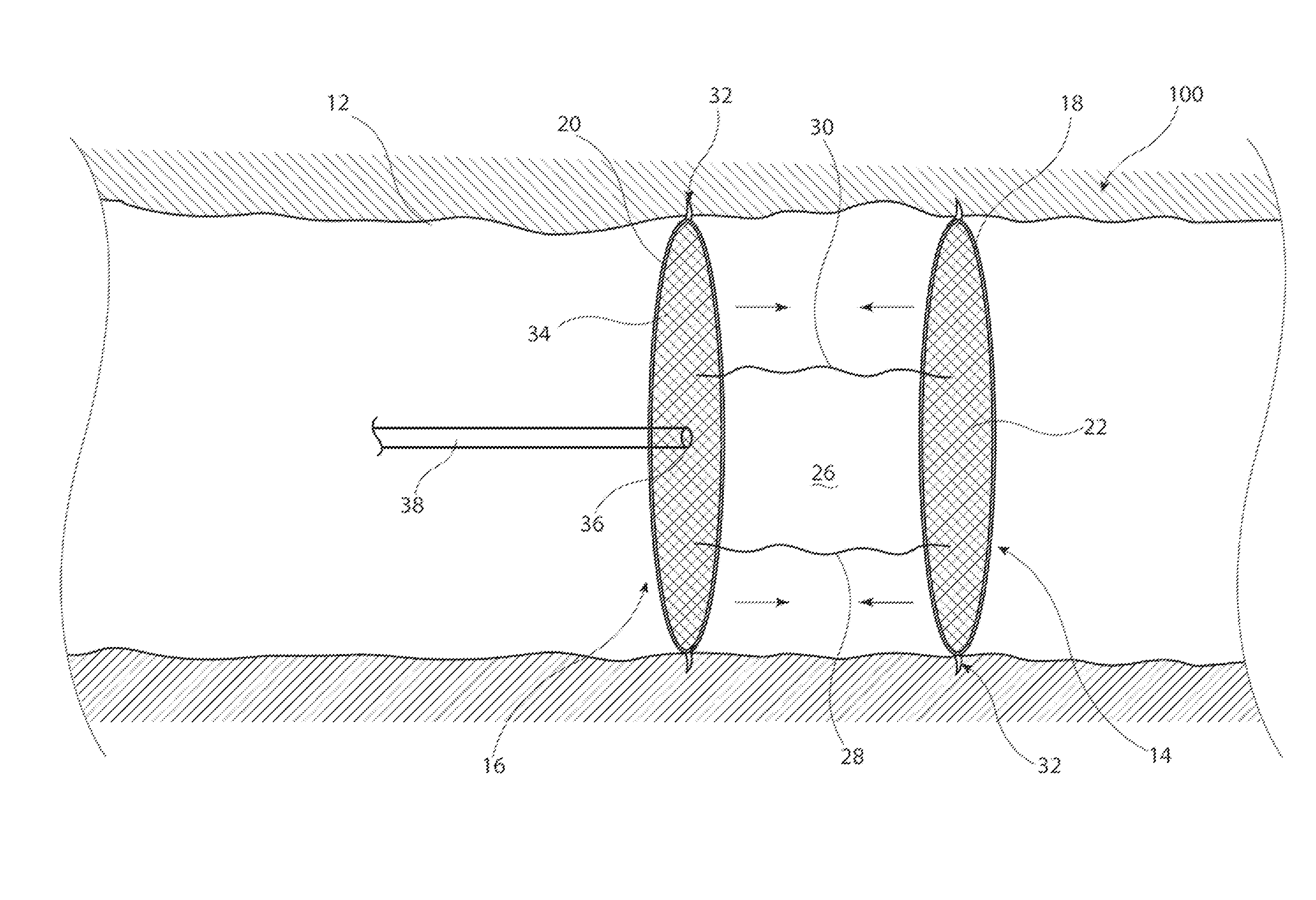 Double baffle vascular occluder