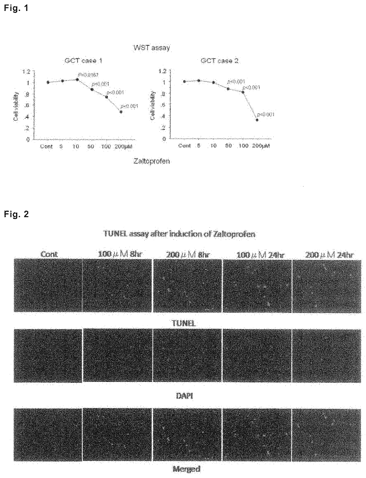 Drug for preventing, treating or preventing metastasis of giant cell tumor that occurs in bone or soft parts, chondrosarcoma, or osteosarcoma, local injection for arterial embolization, and artificial bone