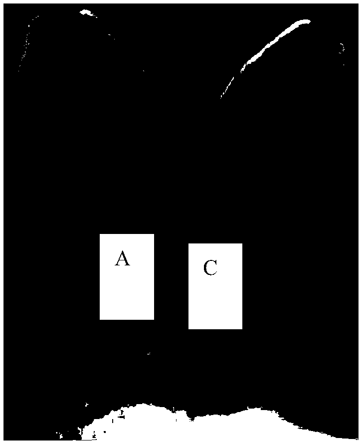 Pharmaceutical composition for treating hemangioma and vascular malformation sclerosis and preparation method and application thereof