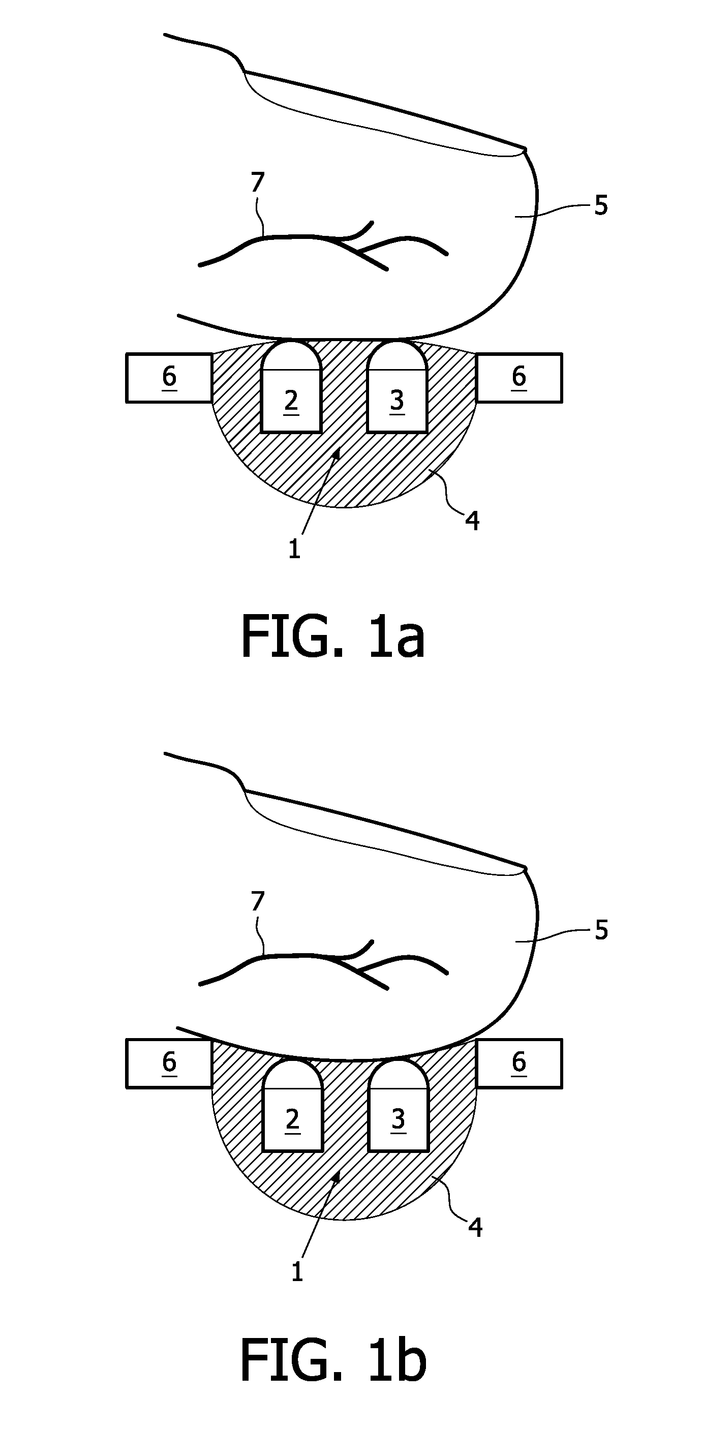 Contactless respiration monitoring of a patient and optical sensor for a photoplethysmography measurement