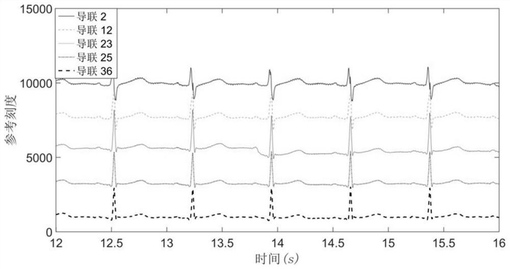 Atrial Fibrillation Analysis and Prediction Method Based on Cardiac Mapping Activation Sequence