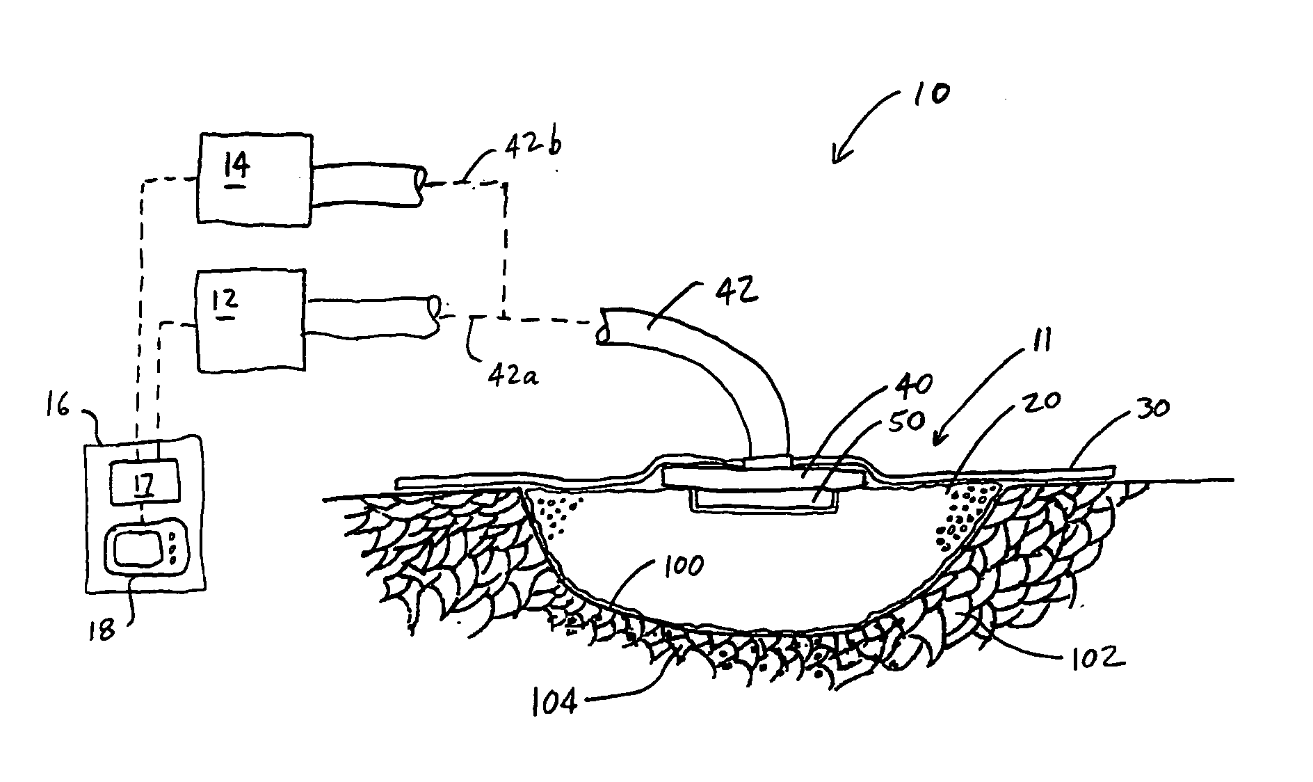 System and method for treating a wound using ultrasonic debribement