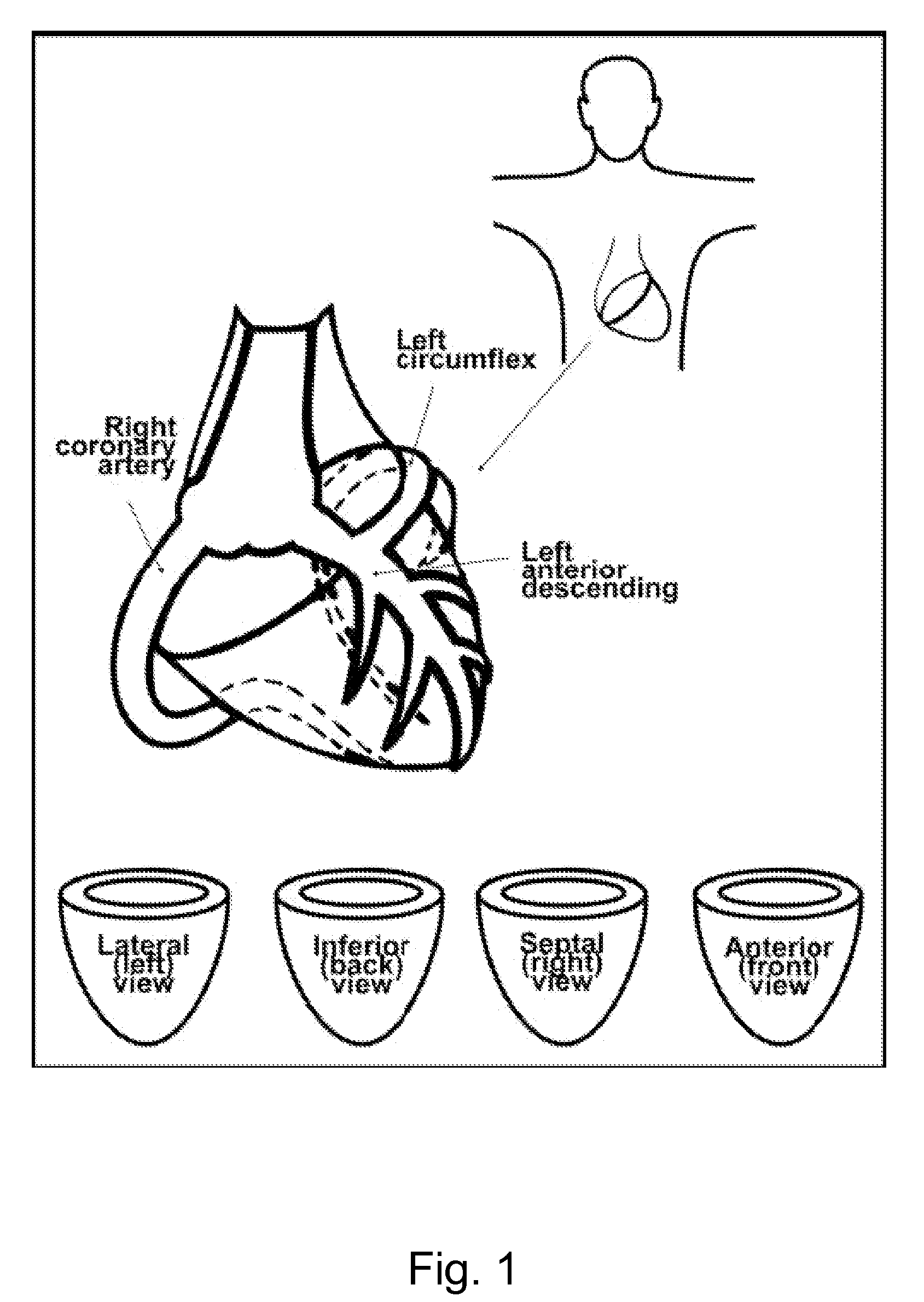 Method for detecting coronary endothelial dysfunction and early atherosclerosis