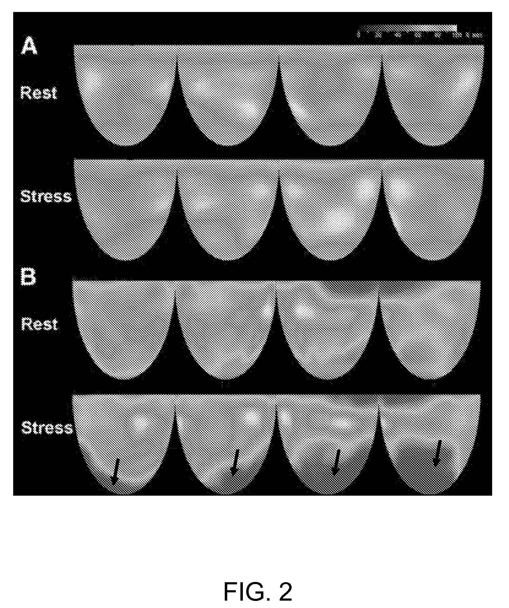 Method for detecting coronary endothelial dysfunction and early atherosclerosis