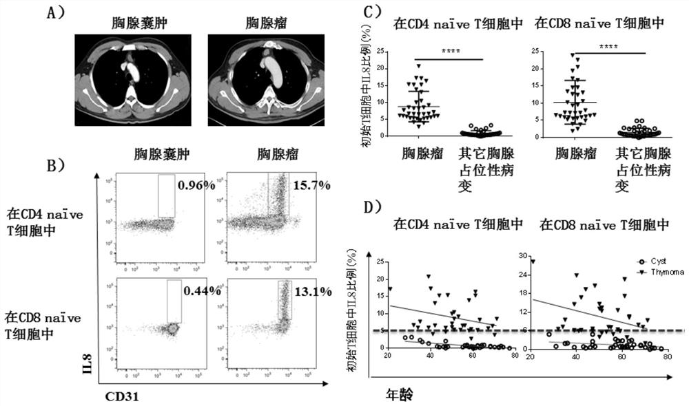 Application of IL-8 positive initial T cell as target for diagnosing thymus space-occupying diseases