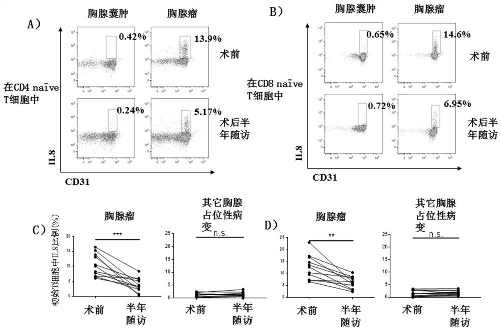 Application of IL-8 positive initial T cell as target for diagnosing thymus space-occupying diseases