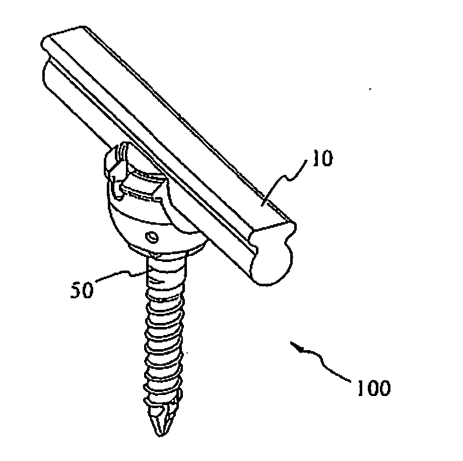 Spine stabilization system