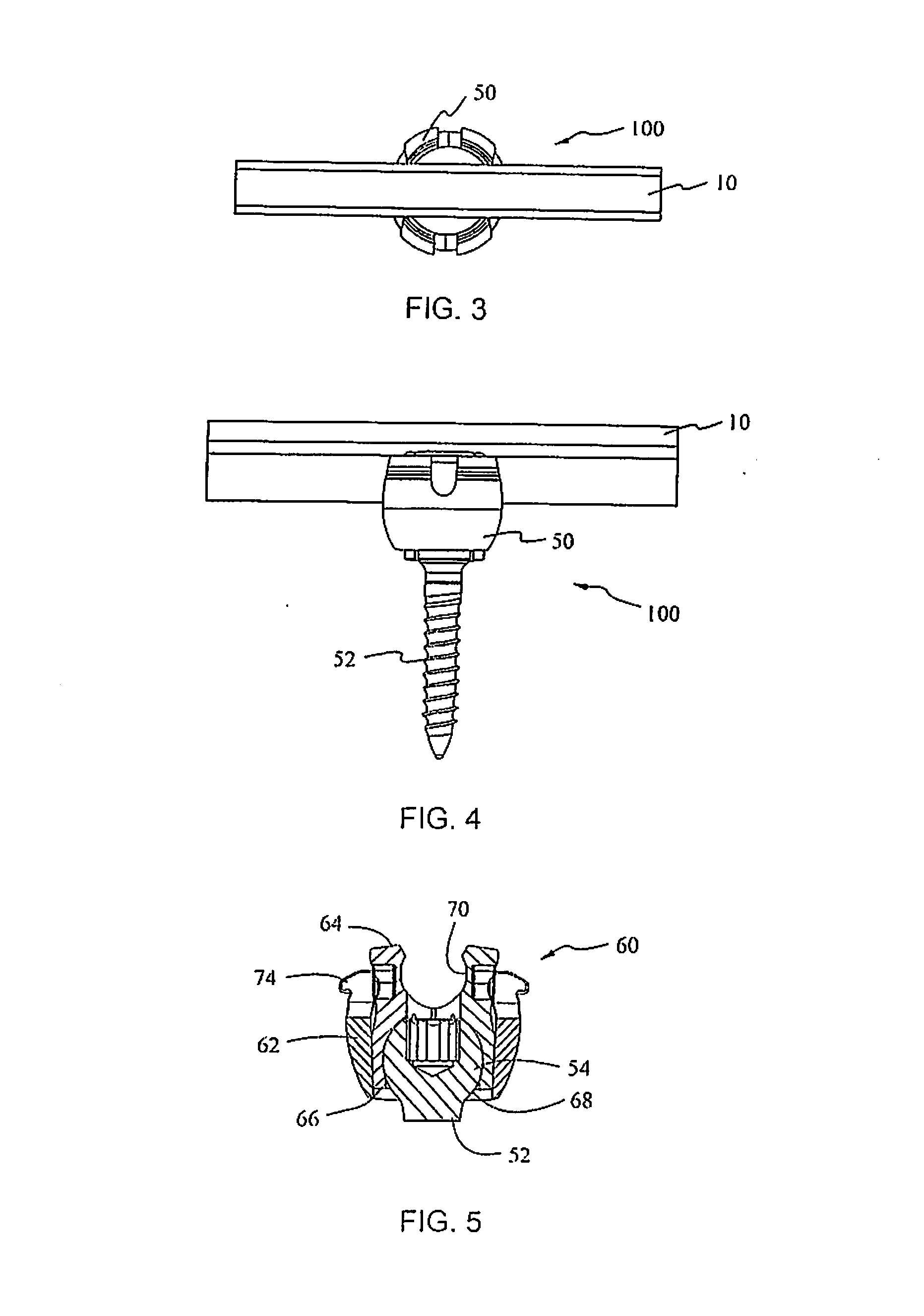 Spine stabilization system