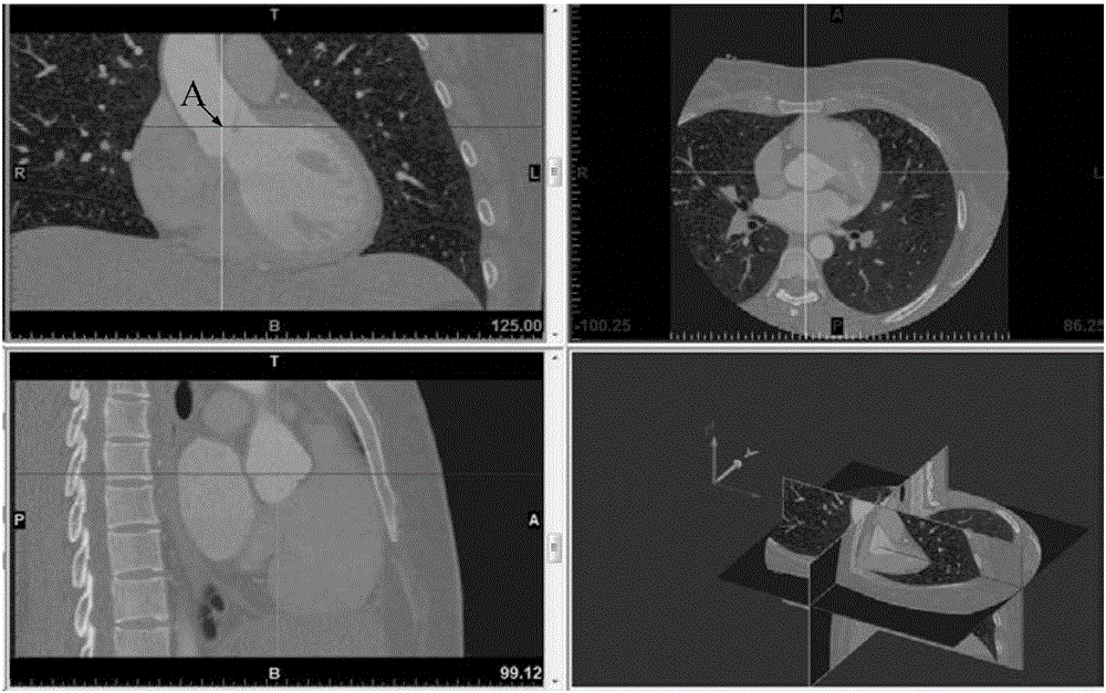 Method, device and system for optimizing performance of cardiac valve prosthesis