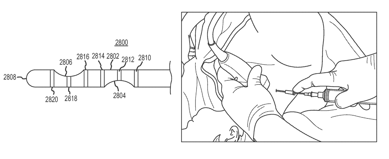 Ultrasound monitored continuous anesthesia nerve conduction apparatus and method by bolus injection