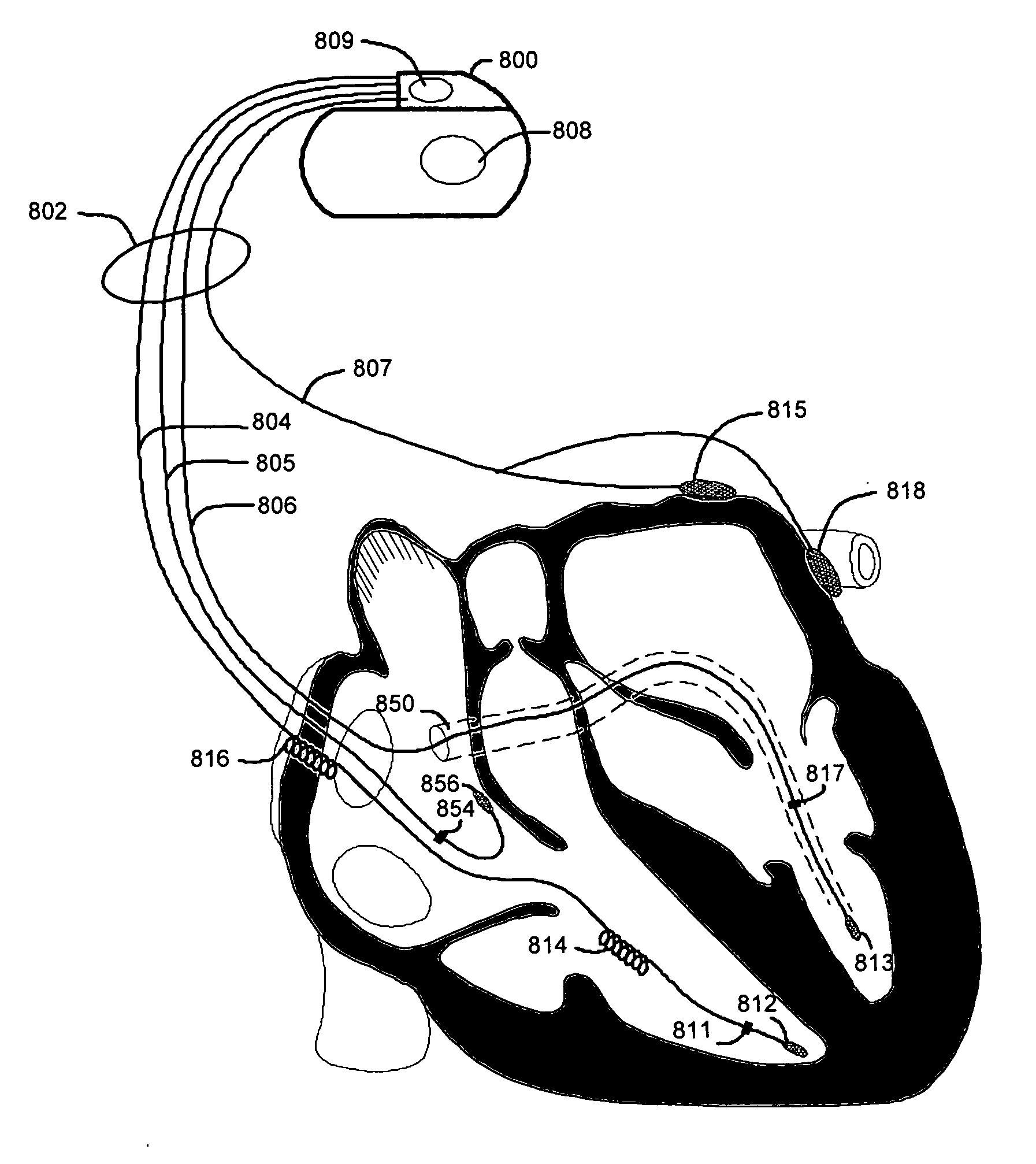 Cardiac resynchronization therapy optimization using cardiac activation sequence information