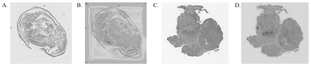 Eyelid tumor digital pathological section image multi-classification method based on deep learning