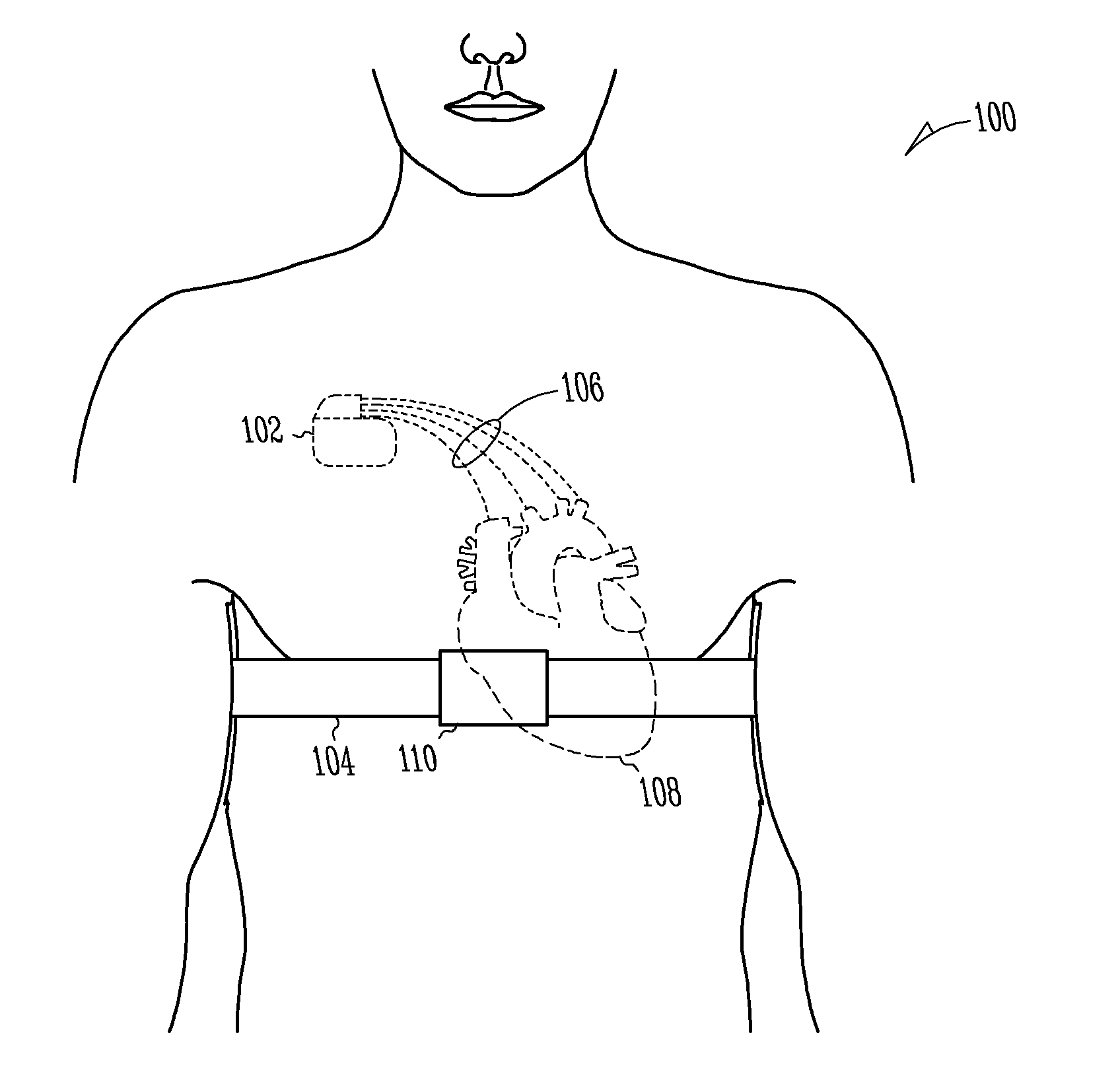 Detection of congestion from monitoring patient response to a recumbent position