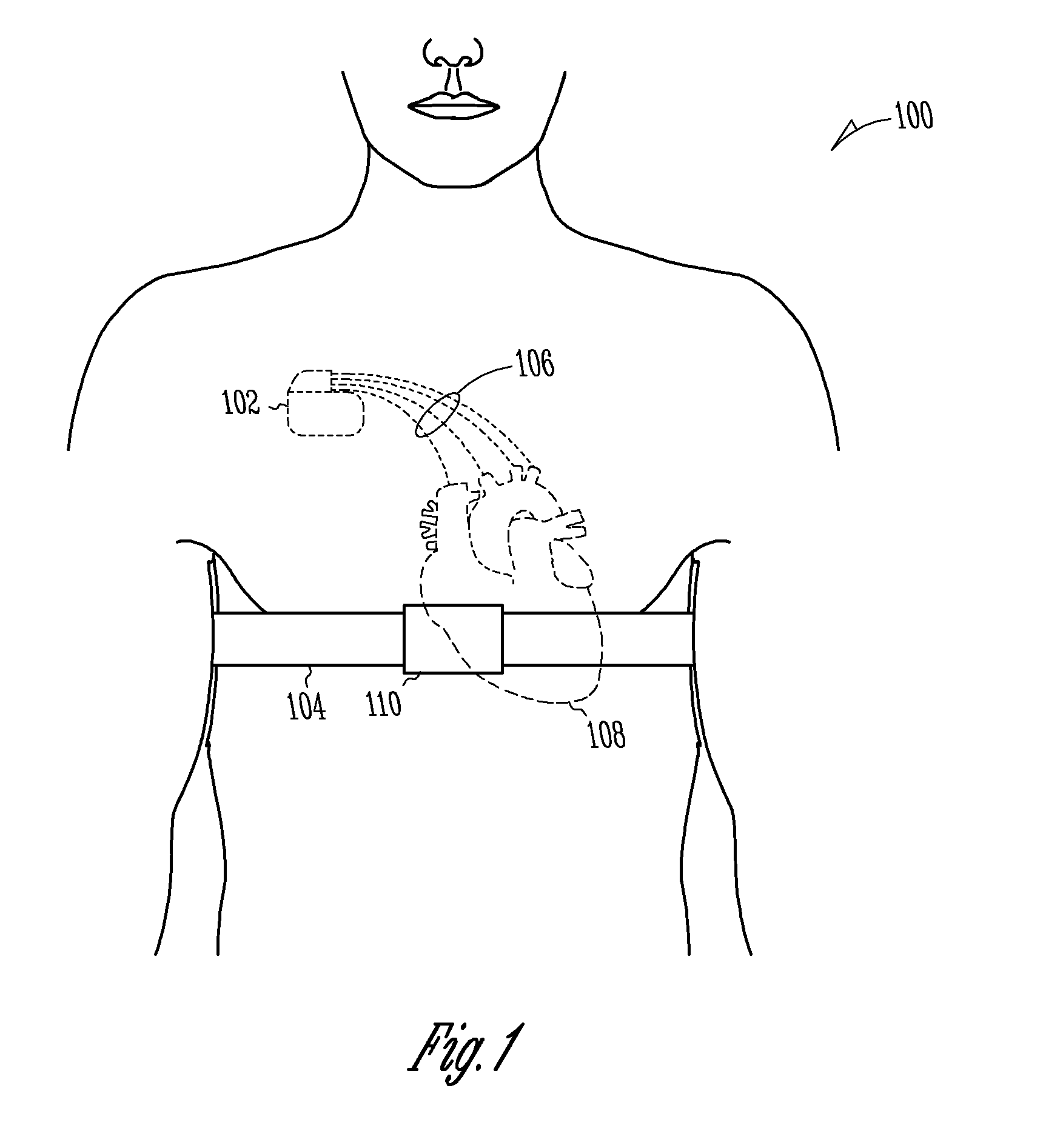 Detection of congestion from monitoring patient response to a recumbent position