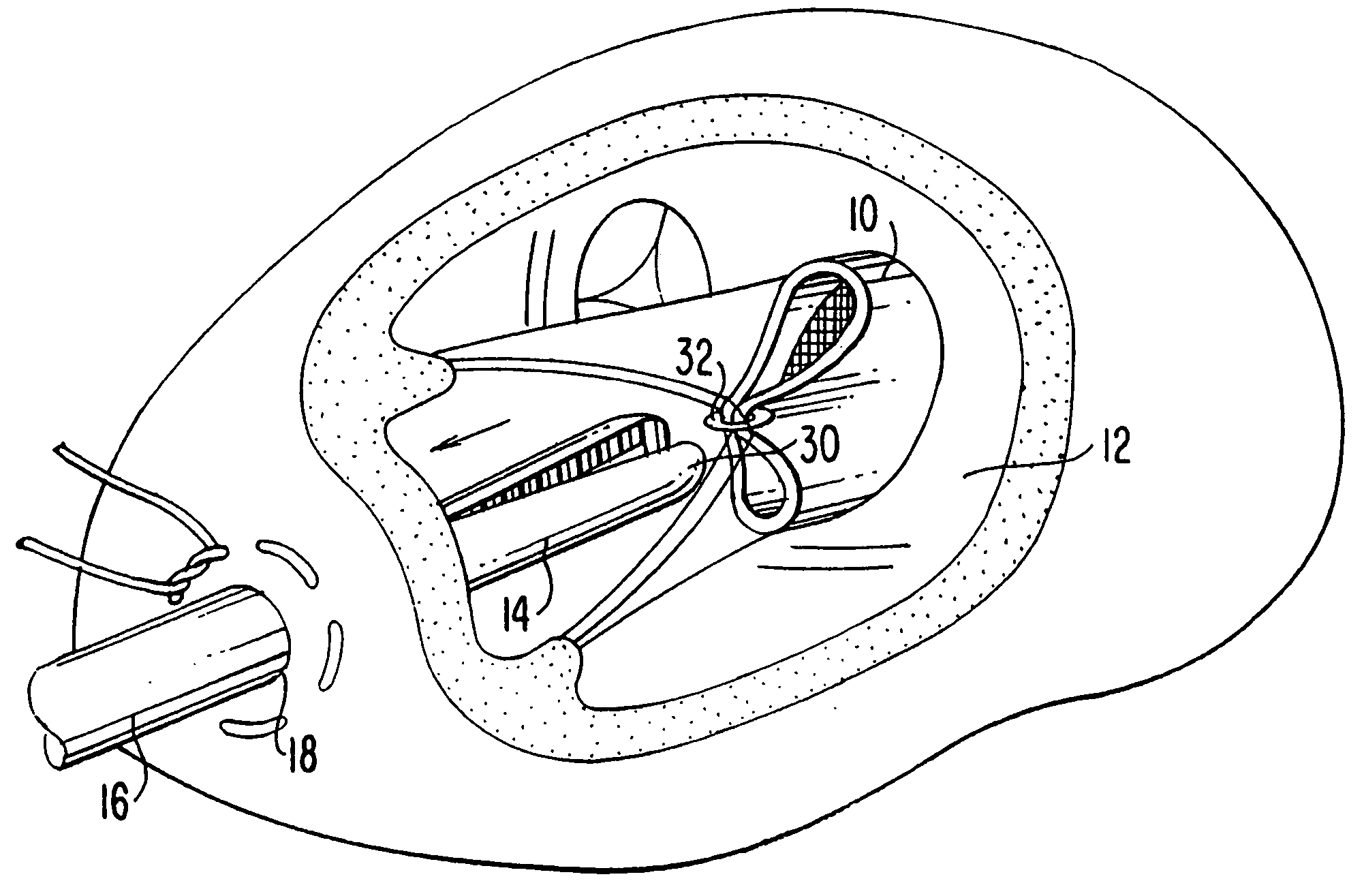 Method and apparatus for circulatory valve repair