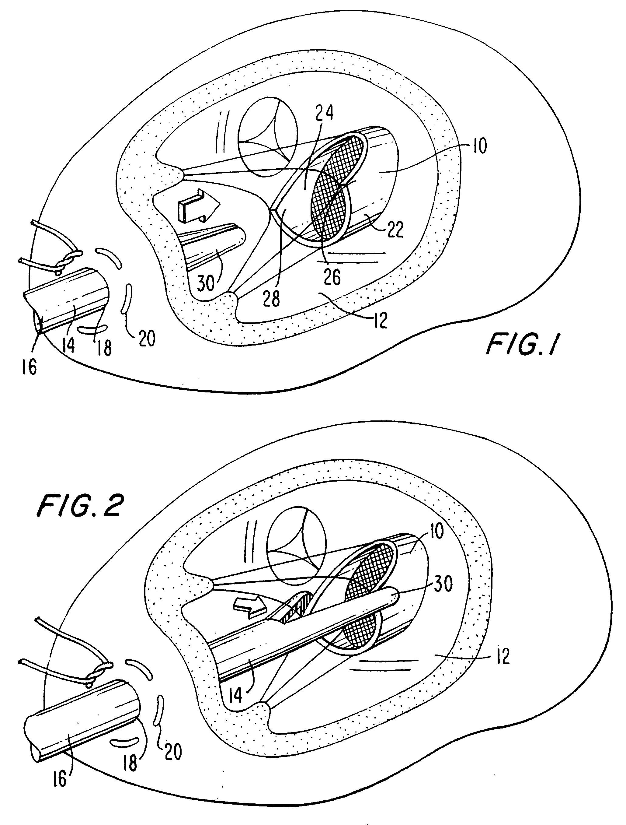 Method and apparatus for circulatory valve repair