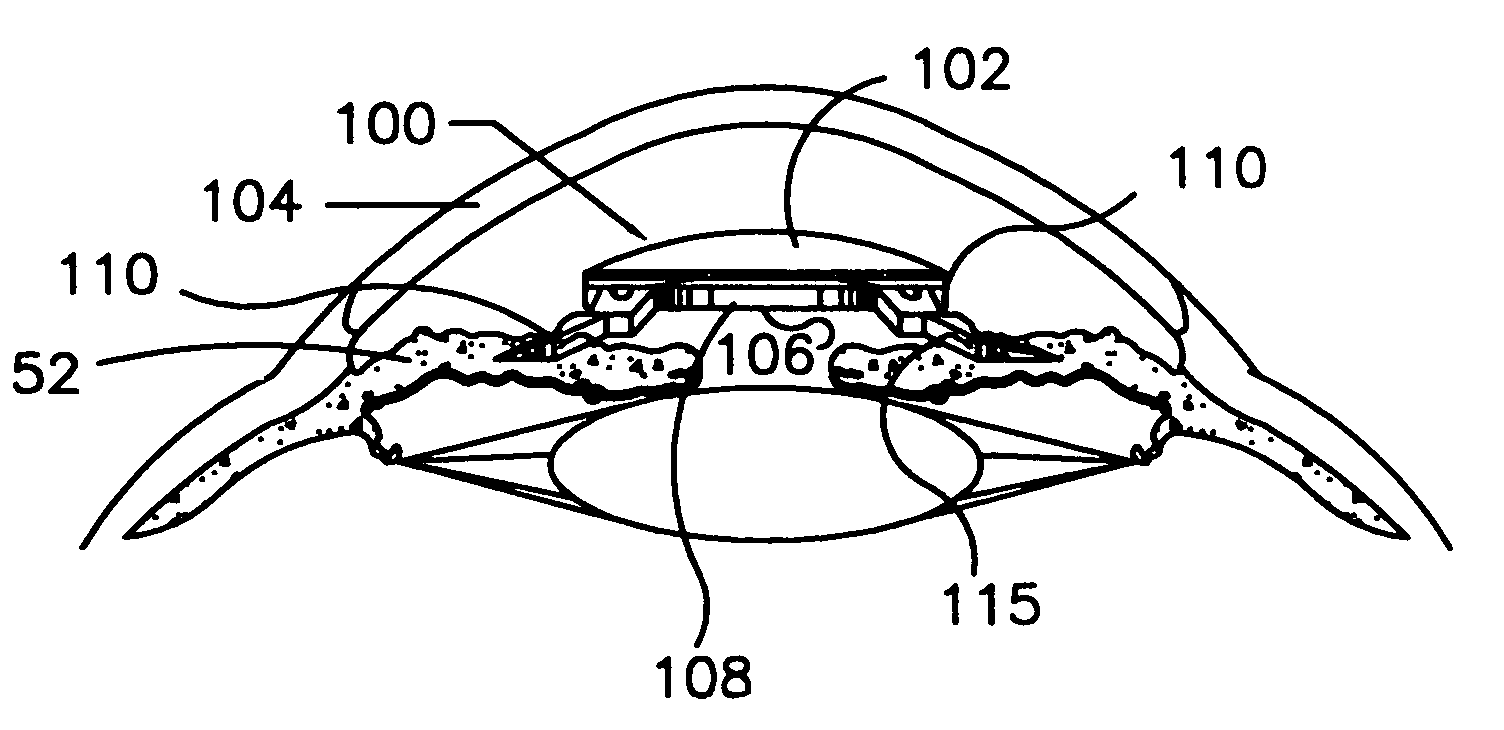 Refractive intraocular implant lens and method