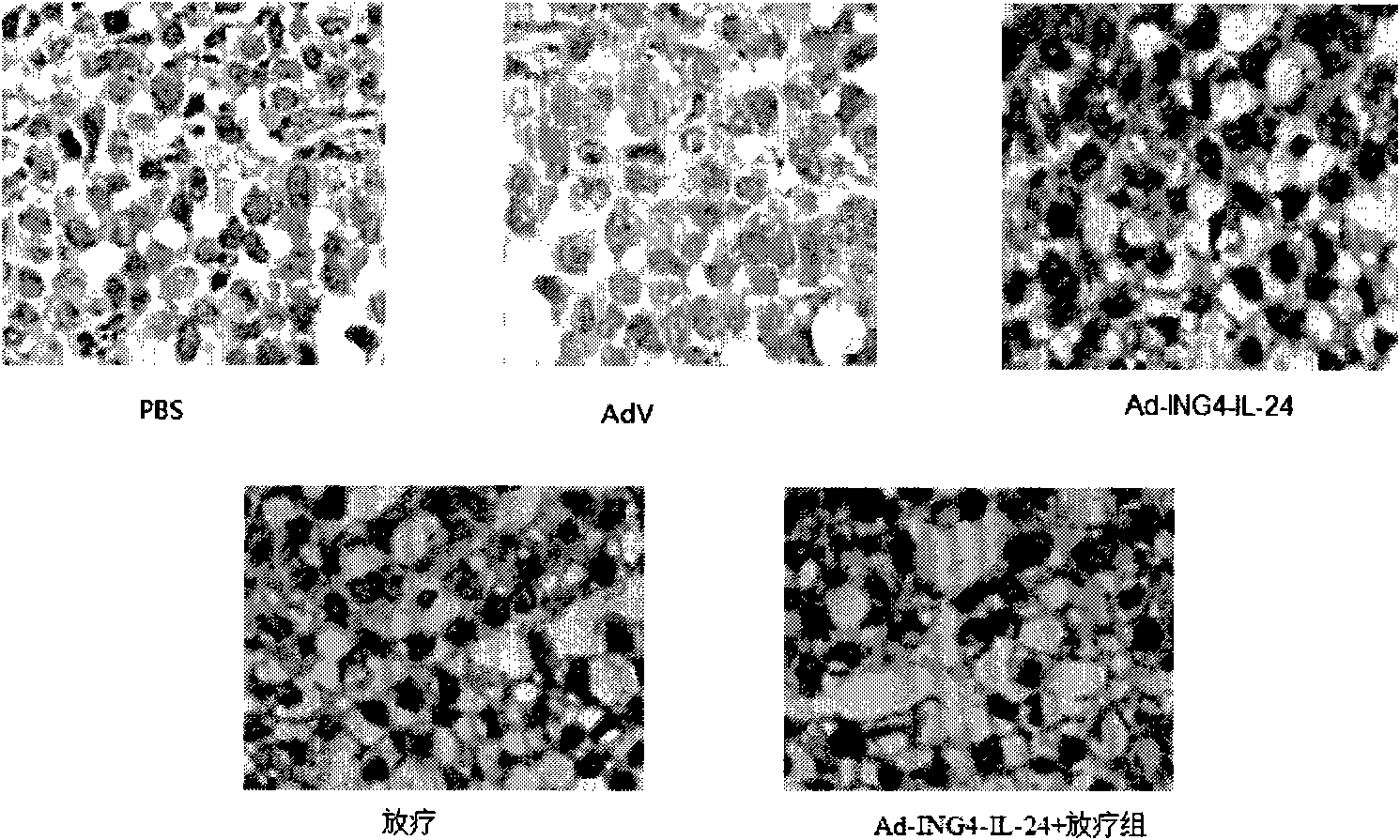 Application of ING4 and IL-24 double-gene coexpression vector as radiotherapy sensitizing agent