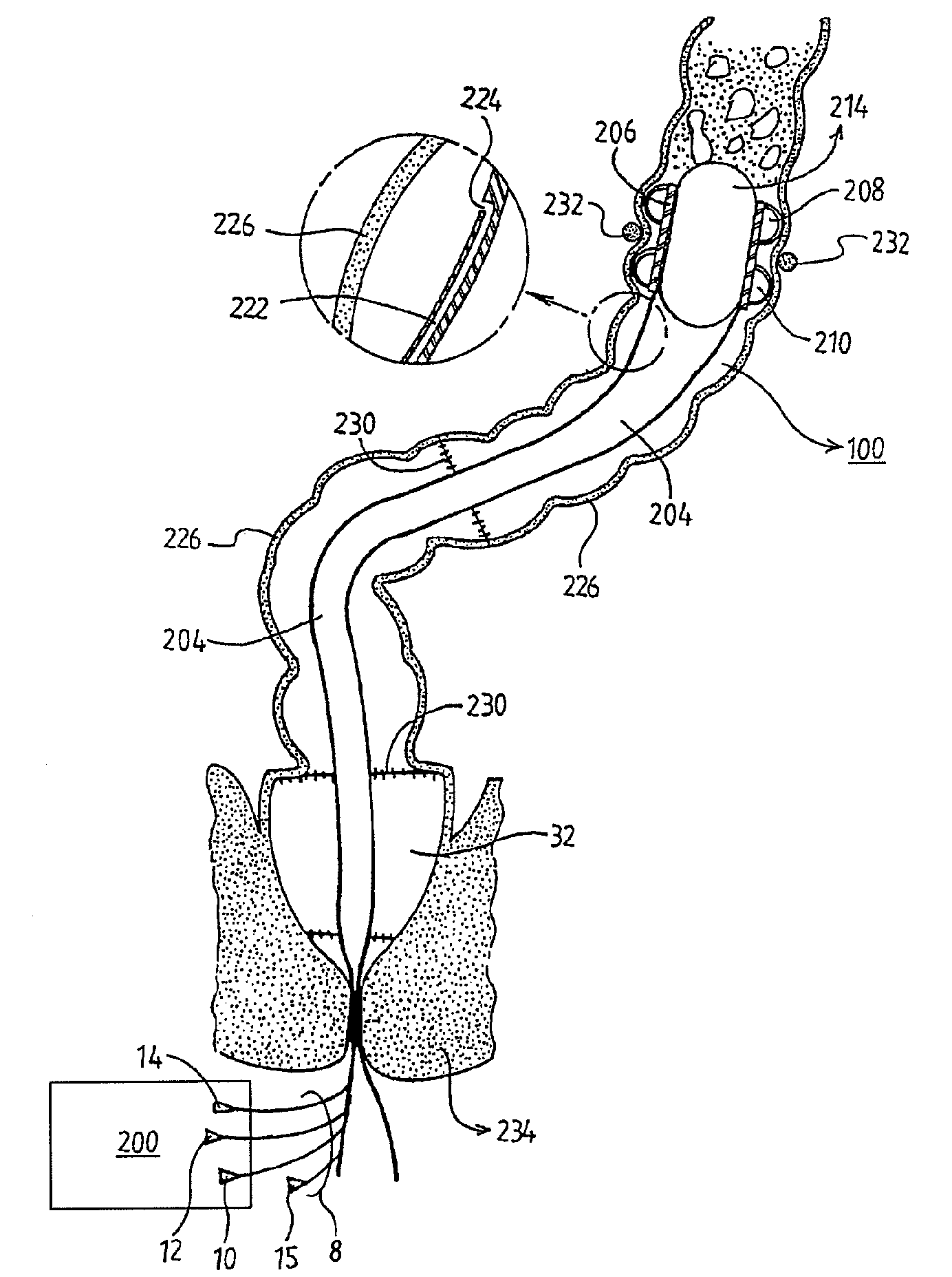 Apparatus and method for controlling fecal diverting device