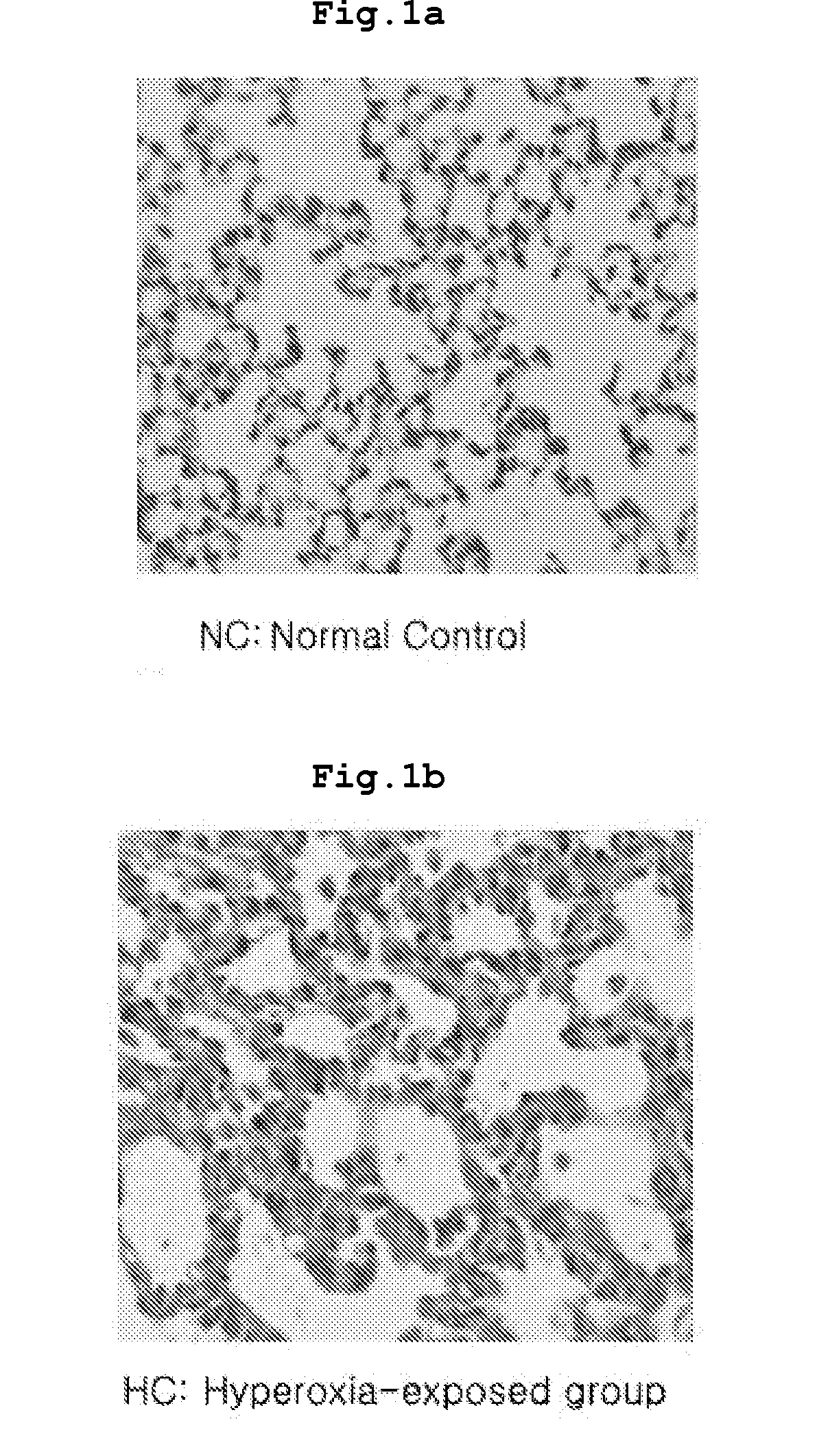 Composition Comprising Separated or Proliferated Cells from Umbilical Cord Blood for Treating Developmental and/or Chronic Lung Disease