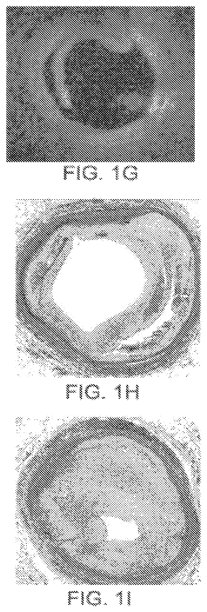 Apparatus and method for treatment of in-stent restenosis