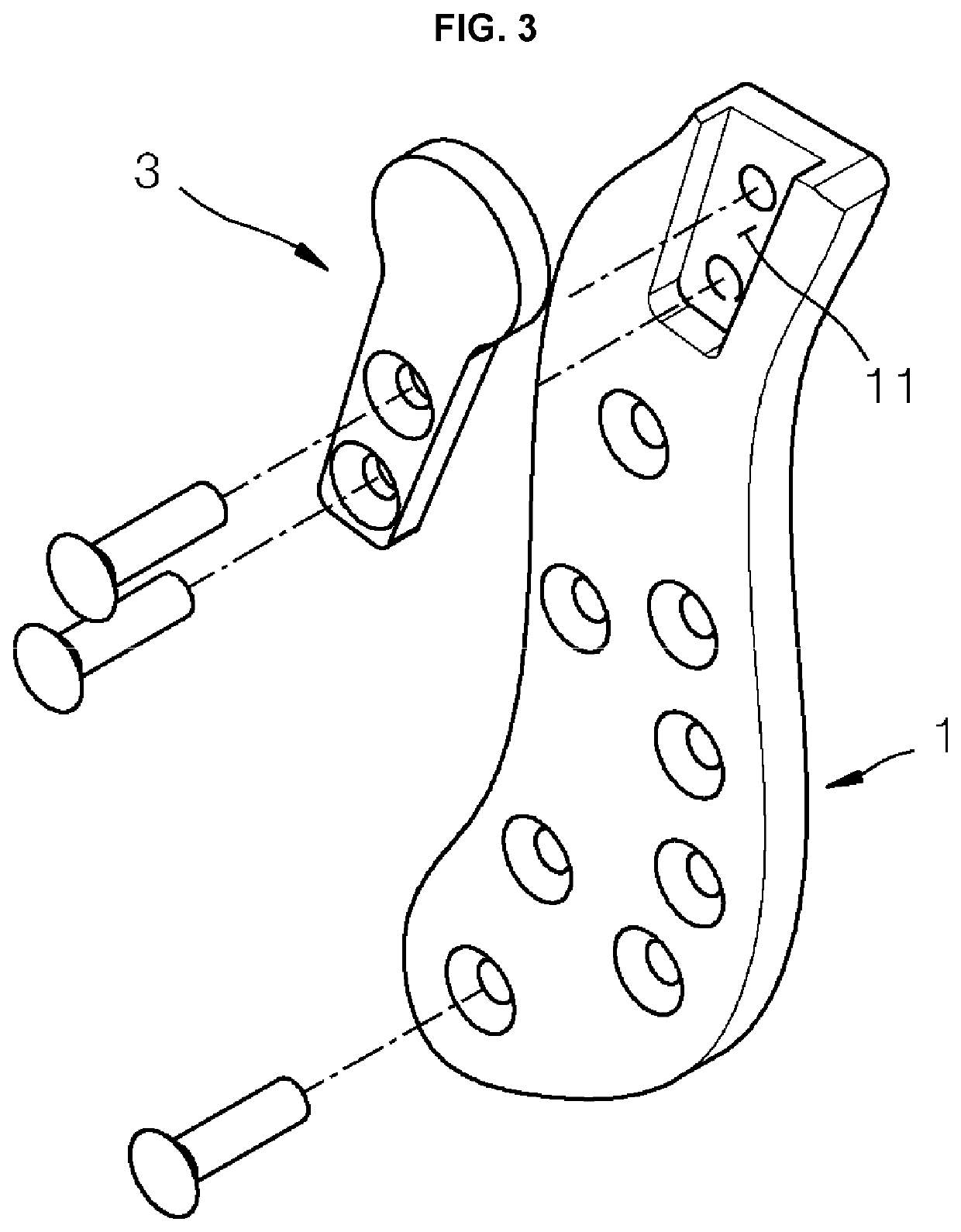 Customized artificial temporomandibular joint unit