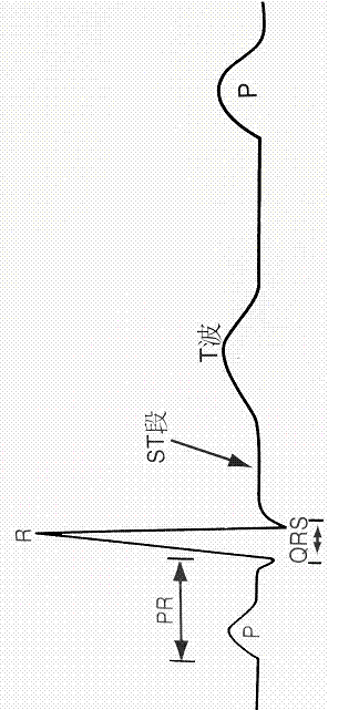 Electrocardio signal QRS complex wave detection method based on morphology and wavelet transform