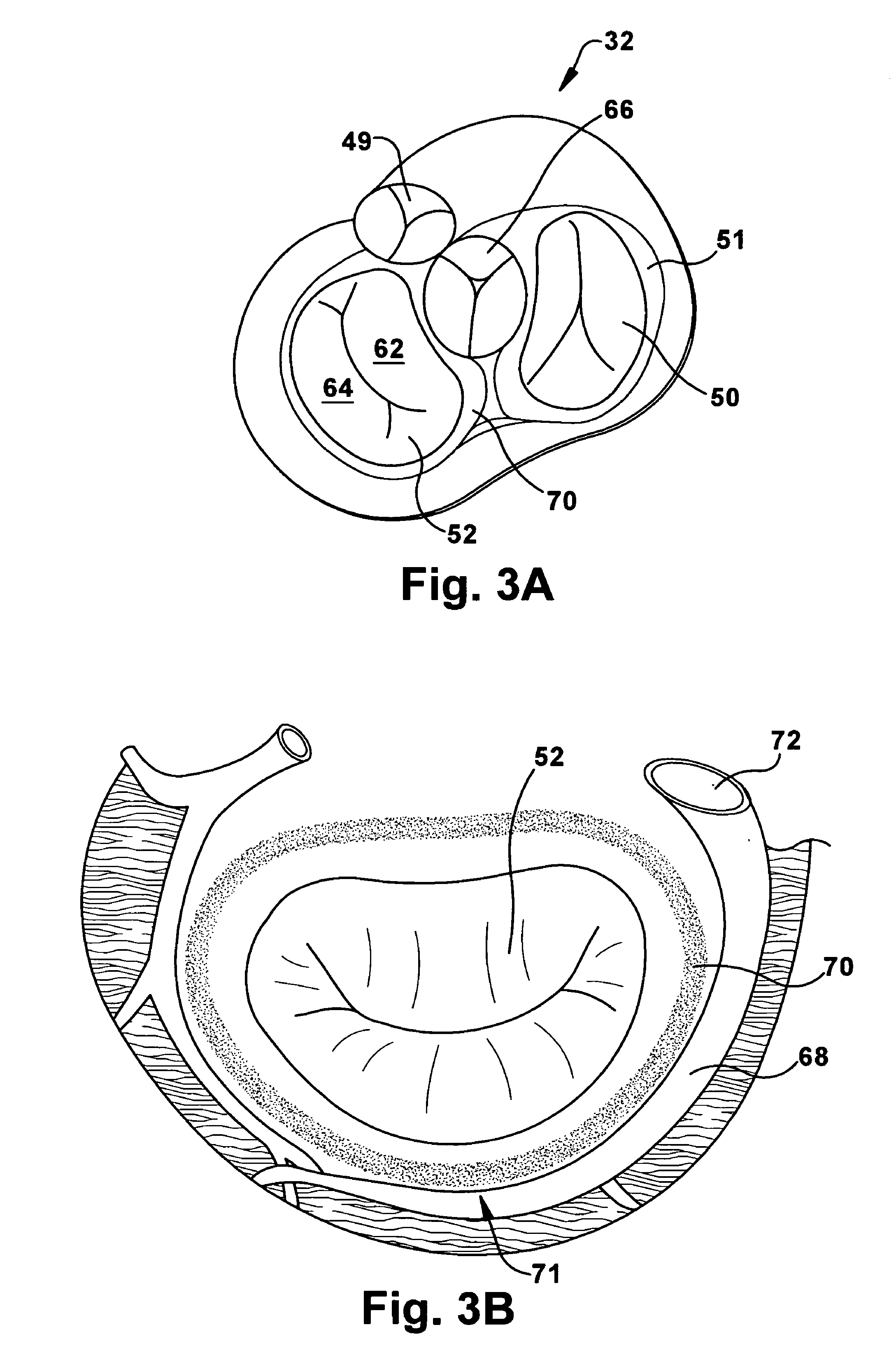 Apparatus and method for treating a regurgitant valve