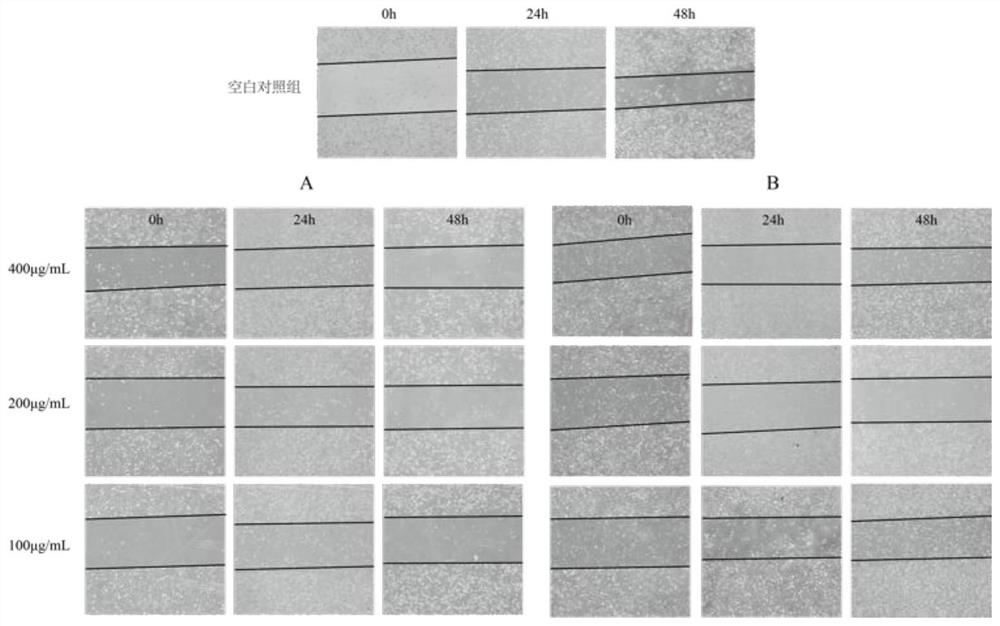 Application of figs and whey thereof in preparation of drugs for inhibiting melanoma and tumor vascular