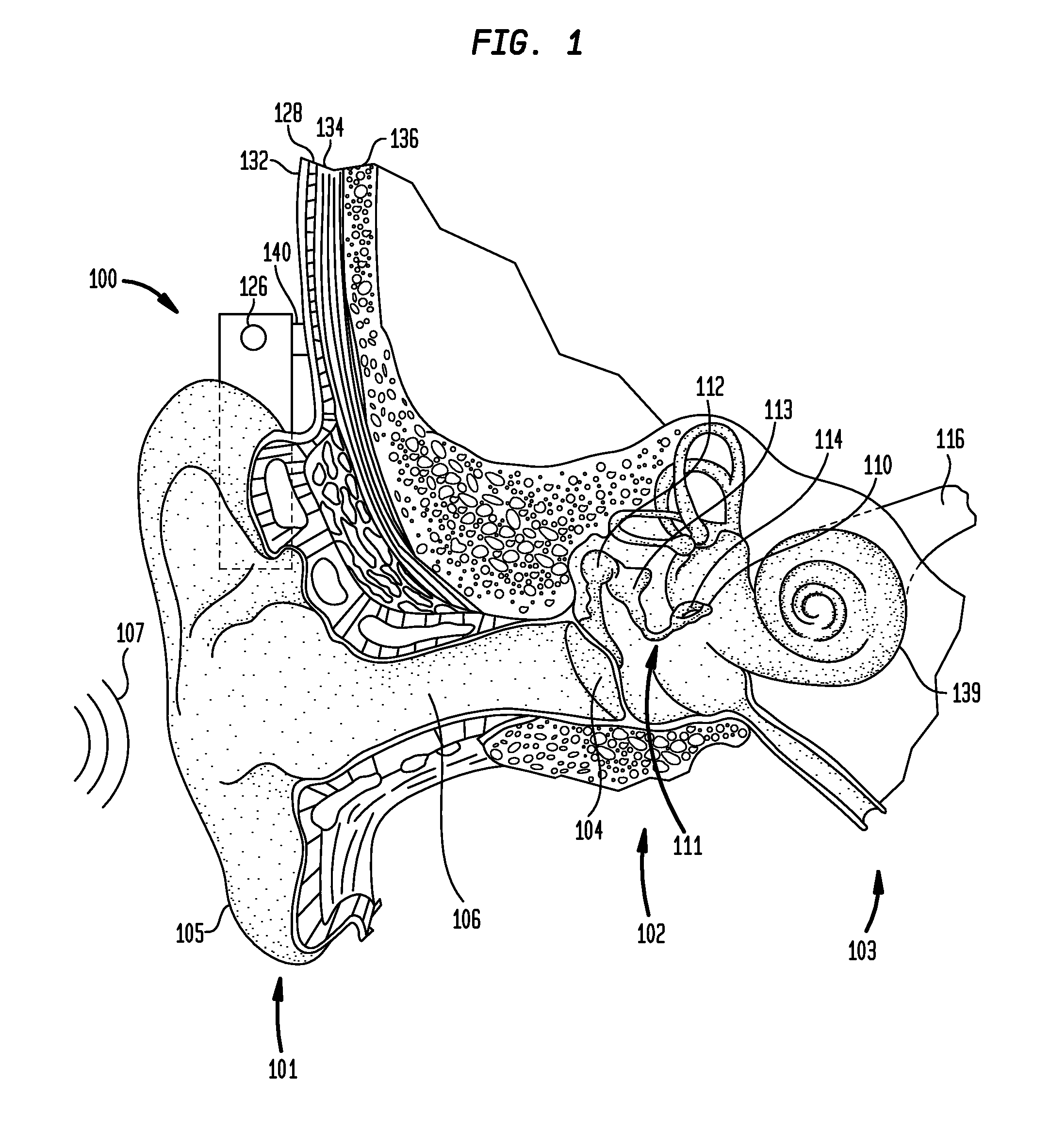 Bone conduction device including a balanced electromagnetic actuator having radial and axial air gaps