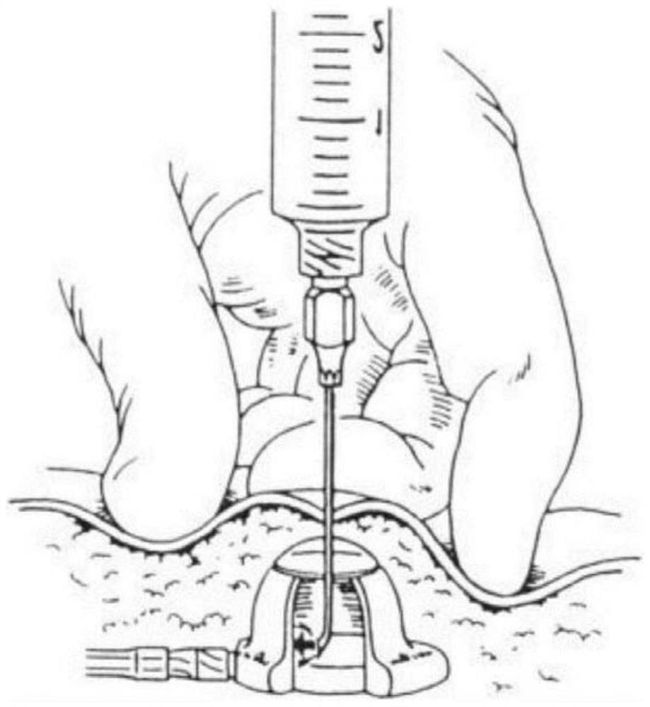 Double-vena cava port capable of preventing thrombosis and preventing secondary infection