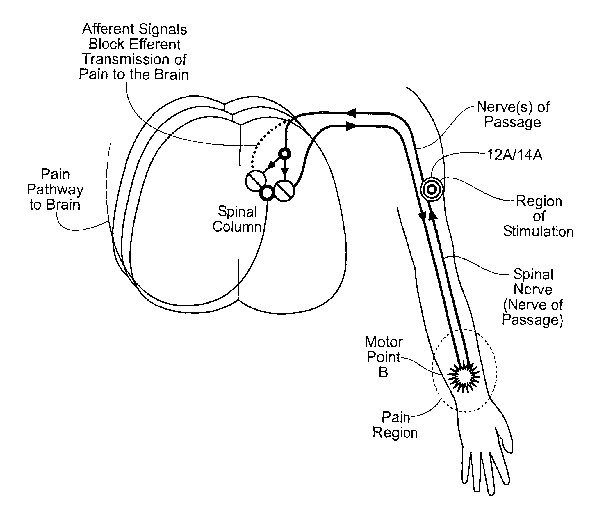 Systems and methods to place one or more leads in tissue to electrically stimulate nerves of passage to treat pain