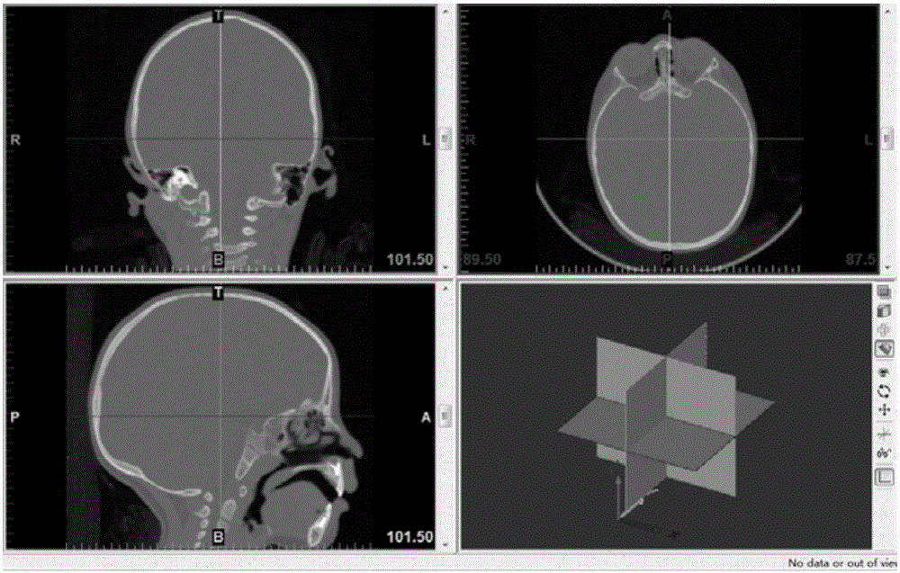 Head thin-layer CT scanning data based frontal bone angle measurement method