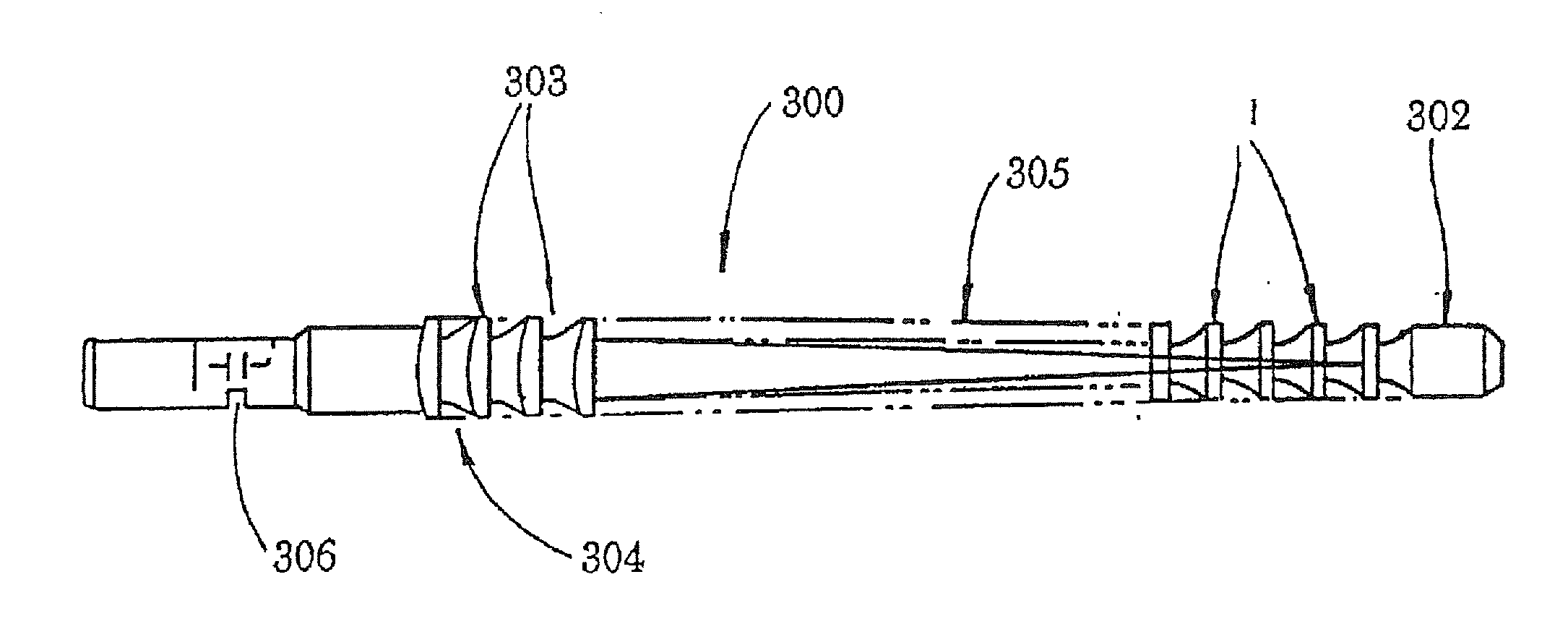 Multi-component cortical bone assembled implant