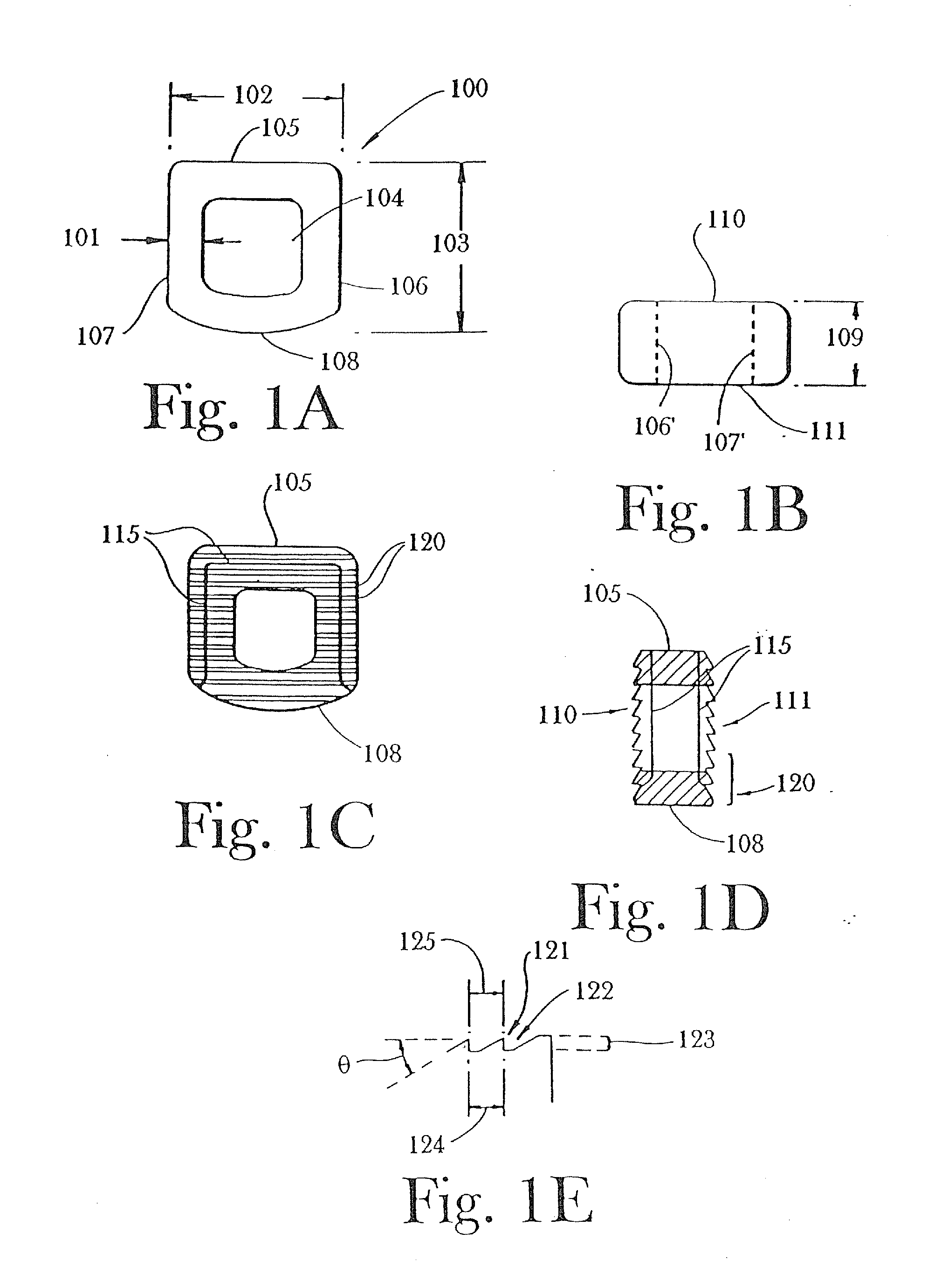 Multi-component cortical bone assembled implant