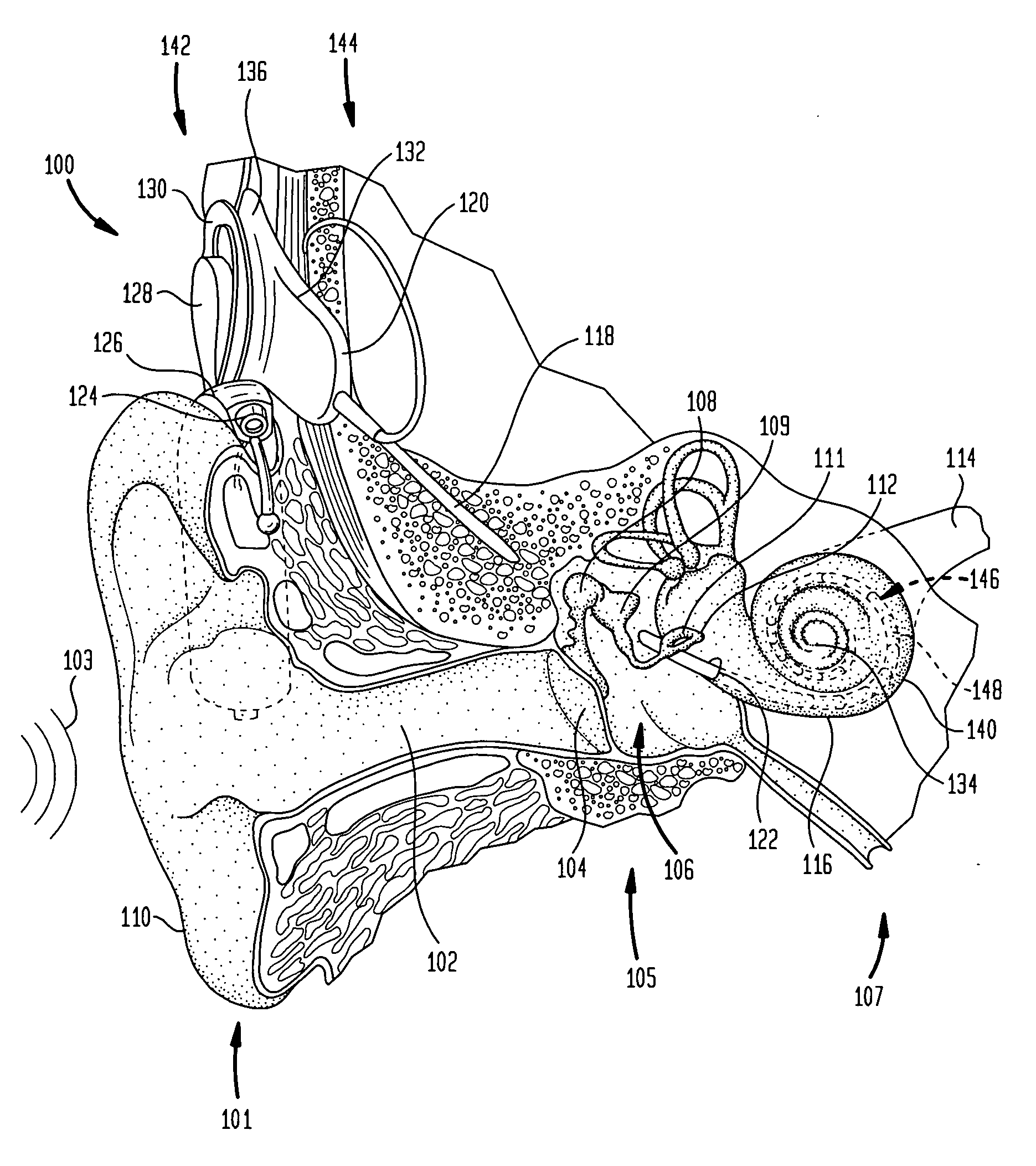 Electrode assembly for a stimulating medical device