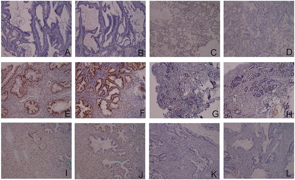 Application of klk13 in the preparation of a detection kit for diagnosing cervical adenocarcinoma