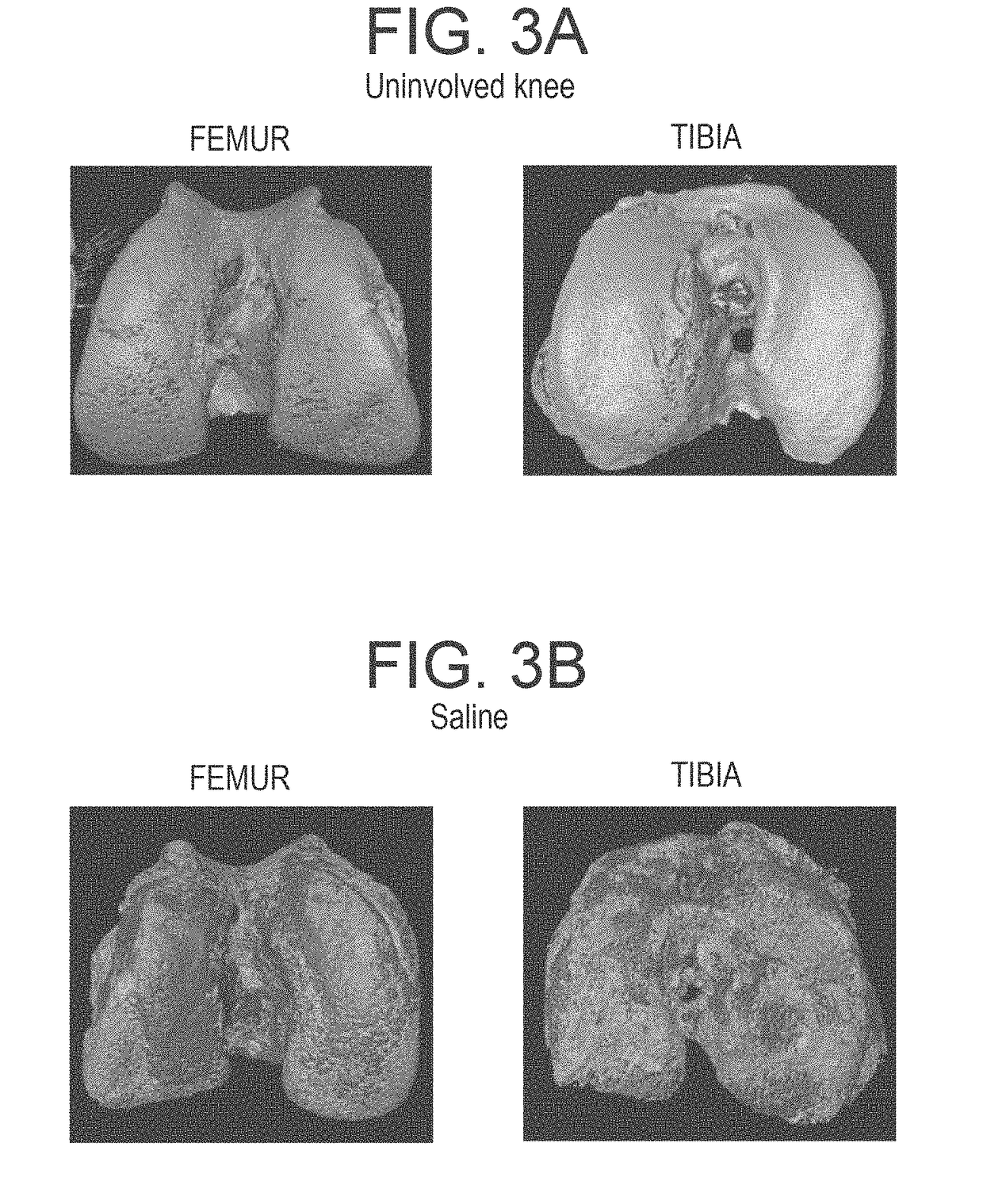 Methods and compositions for treating osteoarthritis and promoting cartilage formation